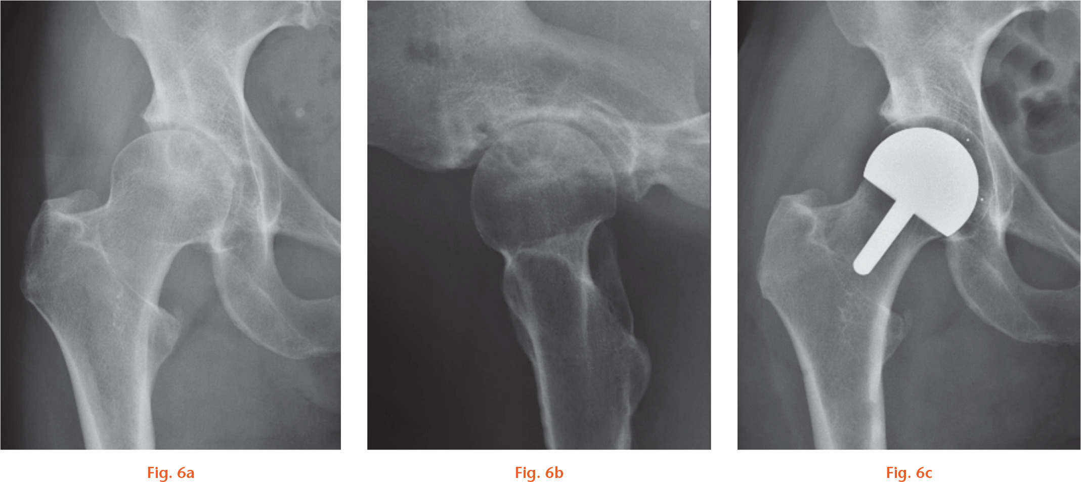 Fig. 6 
          Radiological series of a 50-year-old female expedition travel agent and county golf coach: a) preoperatively; b) immediately postoperatively; and c) at three months. She was unable to work due to pain and requested a hip resurfacing, since her job required maintaining high activity levels. She returned to normal activity at work by three months.
        
