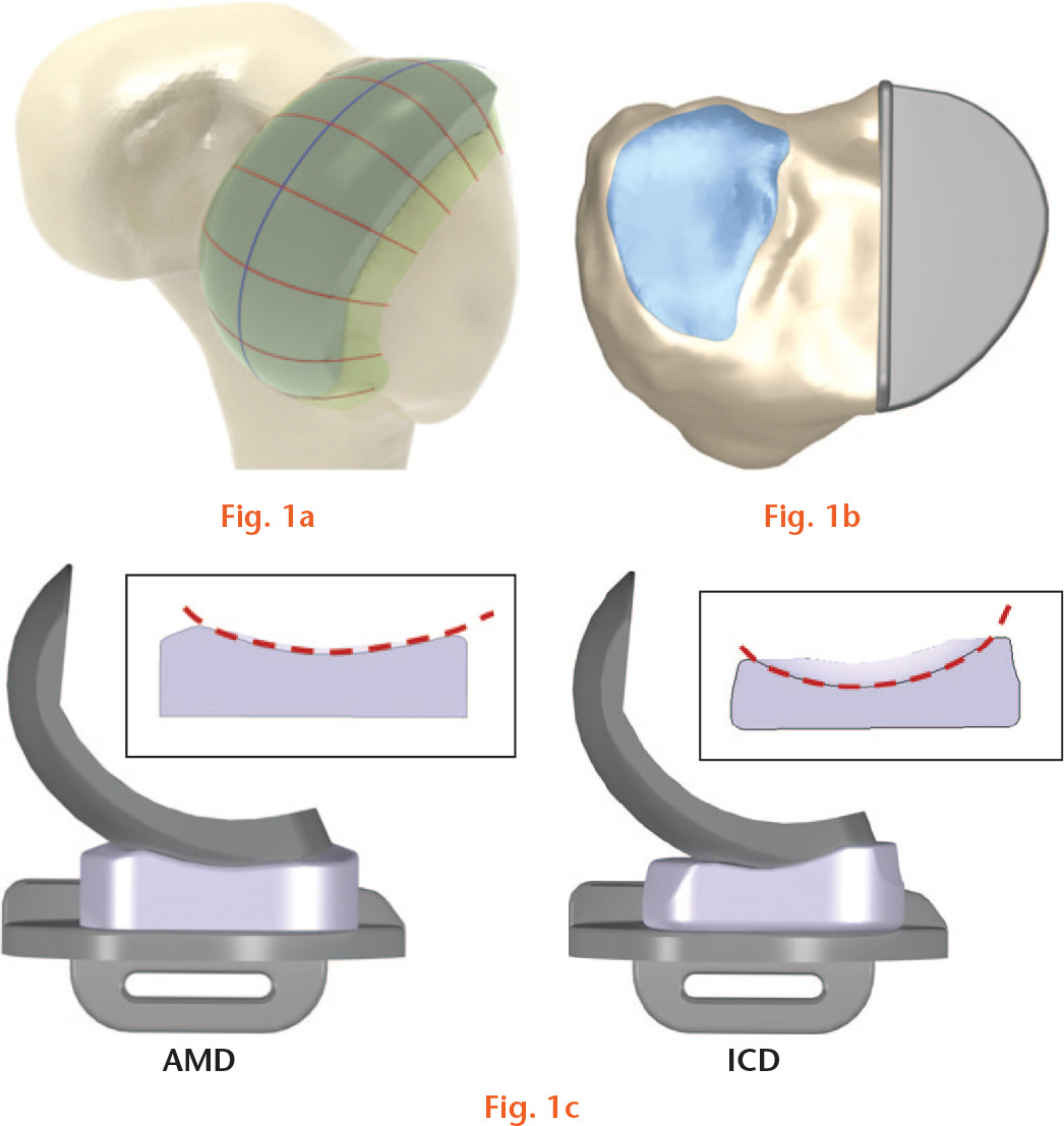 Fig. 1 
          Development of unicompartmental knee arthroplasty (UKA) finite element (FE) models based on patient’s CT and MRI images: a) femoral component; b) tibial component; and c) anatomy mimetic design (AMD) and increased conformity design (ICD) tibial inserts.
        