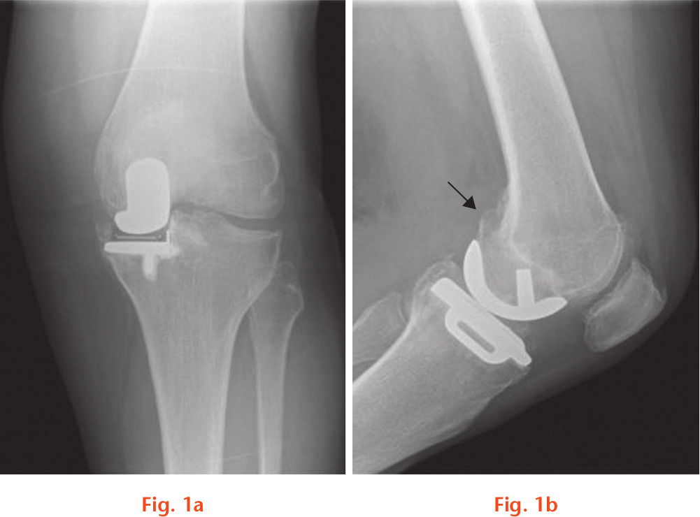 Fig. 1 
            a) Anteroposterior and b) lateral radiographs of a wear outlier patient in the 1050 moulded group. Note that there is a posterior osteophyte, marked by an arrow, that would impinge on the bearing in flexion and cause increased wear.
          