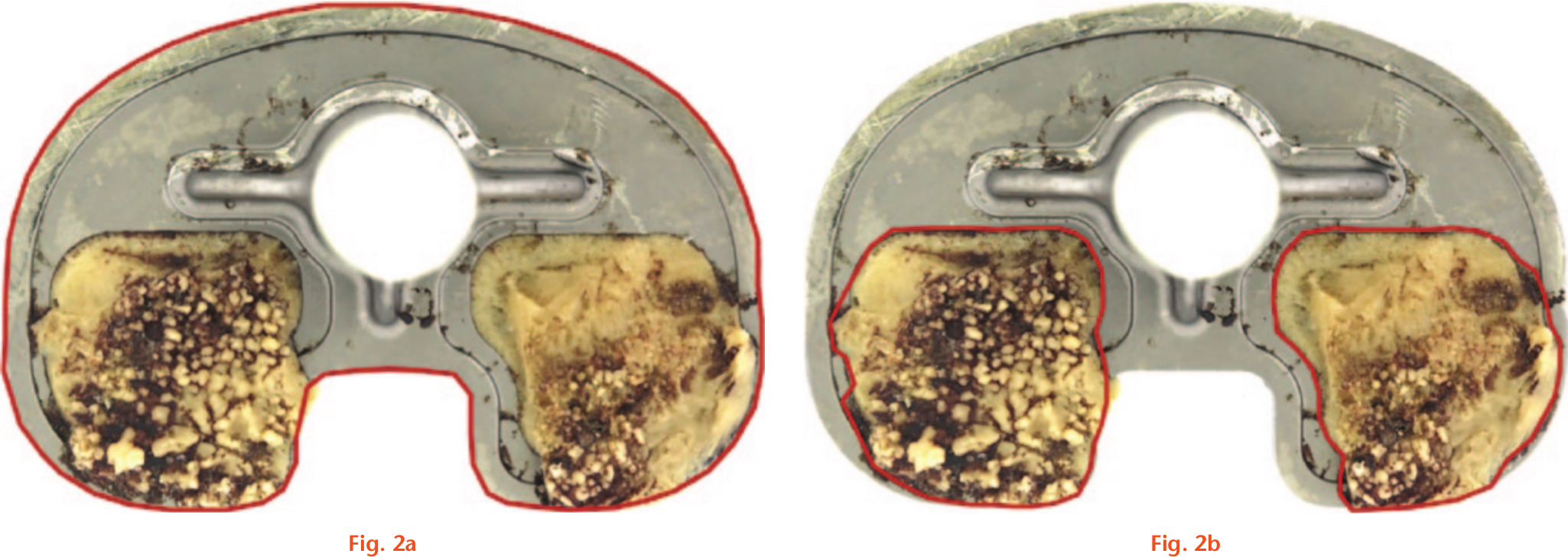 Fig. 2 
            Example of sample analyzed using the photogrammetric method.20,21 a) Total tibial tray backside surface contours highlighted in red. b) Amount of surface covered by cement highlighted in red.
          