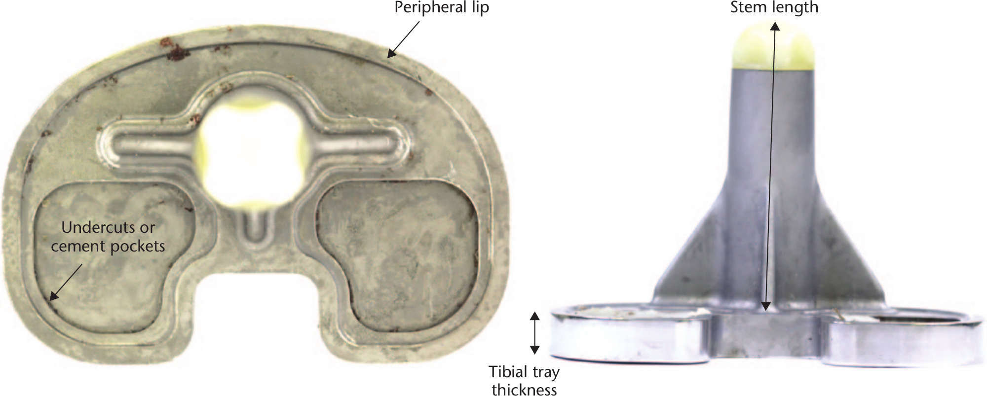 Fig. 3 
            Design features analyzed by visual inspection: undercuts or cement pockets, peripheral lips,23 tibial tray thickness, and stem length.
          