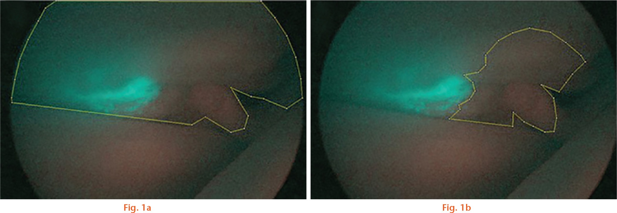 Fig. 1 
            Anterolateral area of a rotator cuff tear observed at the time of indocyanine green (ICG) fluorescence angiography. a) The area surrounded by yellow lines is the area of the rotator cuff; this area was measured using ImageJ/Fiji 1.46 software. b) The area surrounded by yellow lines is the hypovascular area in the rotator cuff; this area was measured using ImageJ/Fiji 1.46 software. The ratio of the hypovascular area to the total area of the rotator cuff was calculated.
          