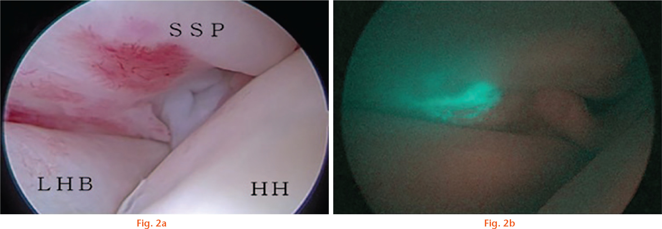 Fig. 2 
          a) Anterolateral area of a rotator cuff tear observed before indocyanine green (ICG) fluorescence angiography; b) Anterolateral area of a rotator cuff tear observed at the time of ICG fluorescence angiography. SSP, supraspinatus tendon; LHB, long head of biceps brachii; HH, head of humerus
        