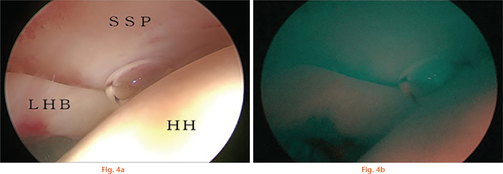Fig. 4 
          a) Anterolateral area of adhesive capsulitis observed before ICG fluorescence angiography; b) Anterolateral area of adhesive capsulitis observed at the time of ICG fluorescence angiography. SSP, supraspinatus tendon; LHB, long head of biceps brachii; HH, head of humerus.
        