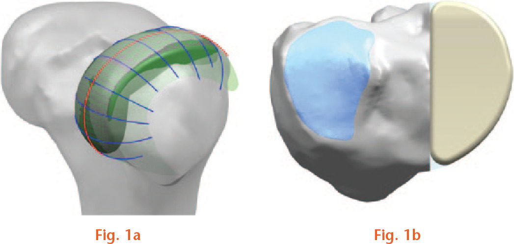 Fig. 1 
            Development of the patient-specific unicompartmental knee arthroplasty (UKA) model based on using the patient’s CT and MRI images: a) femoral component; b) tibial component.
          