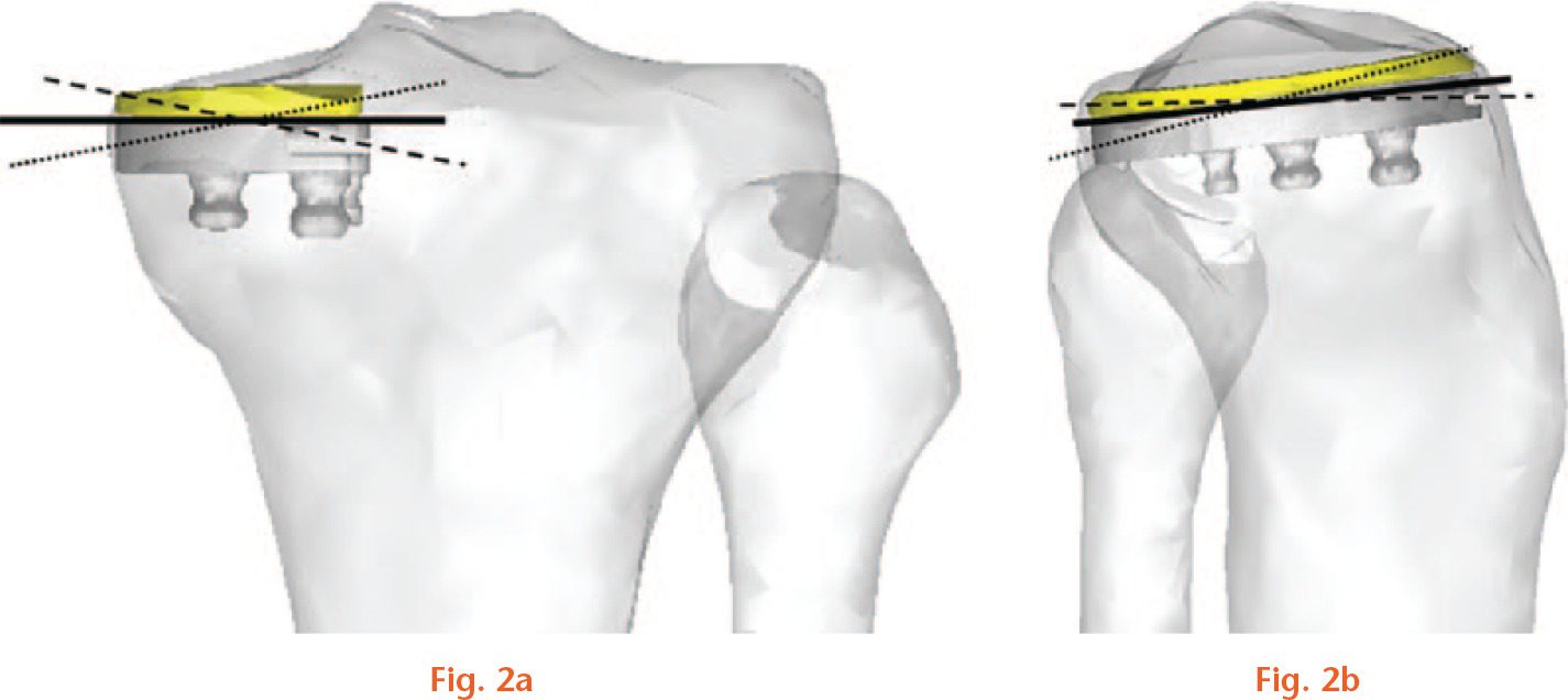 Fig. 2 
          The schema of a) coronal and b) sagittal models analyzed in this study. Coronal model: varus 6° to valgus 4°, posterior slope 7°. Sagittal model: varus/valgus 0° (neutral), posterior slope 0° to 11°.
        