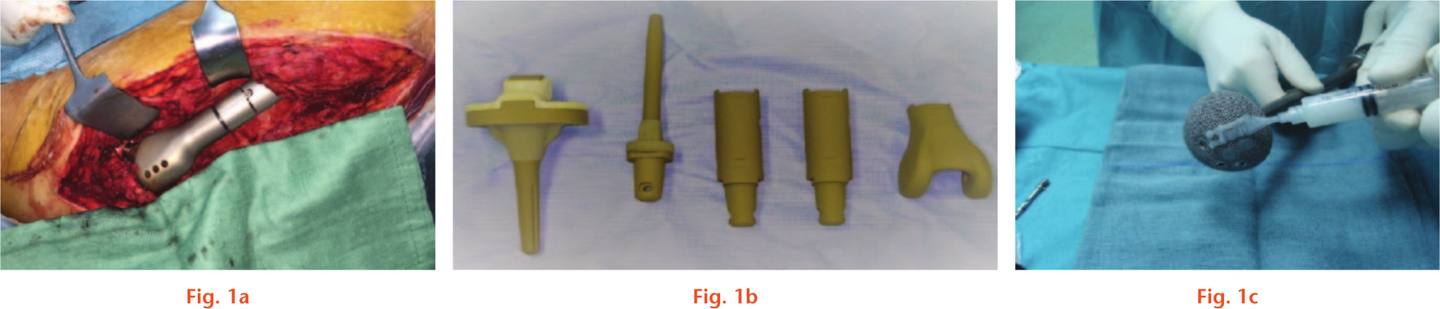 Fig. 1 
          Examples of antibacterial coating of joint prosthesis: a) silver-coated hip tumour prosthesis; b) iodine-coated tumour prosthesis; c) vancomycin-loaded Defensive Antibacterial Coating (DAC) hydrogel, applied at surgery on an acetabular titanium component.
        