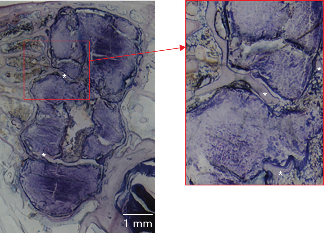 Fig. 5 
          Toluidine Blue (TolBlue)-stained section showing typical host response to an implanted screw (PLGA-TCP after 36 weeks in this instance), with bone ingrowth into cracks indicated with * and highlighted in the magnified area of interest. PLGA, poly(L-lactide-co-glycolide); TCP, tricalcium phosphate.
        