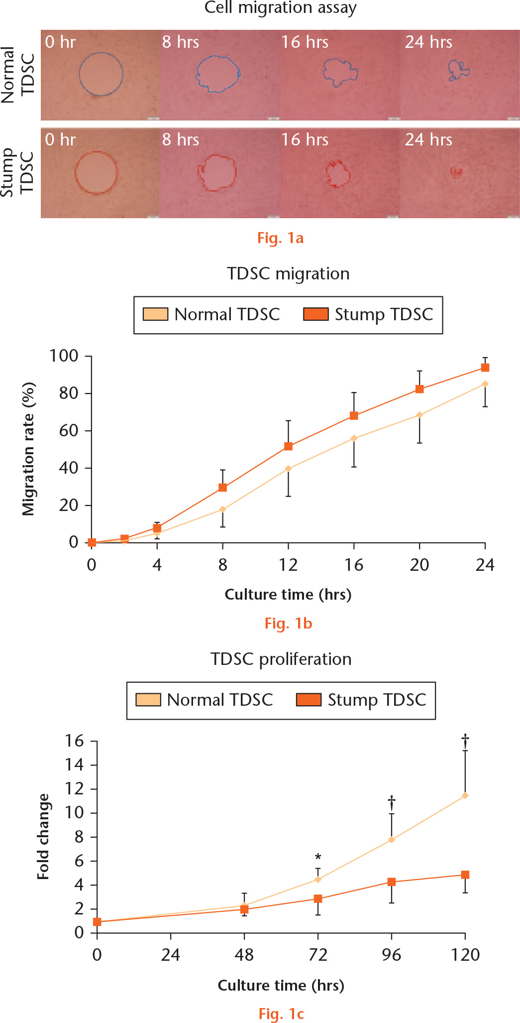 Fig. 1 
            Cell migration and proliferation of stump and normal tendon-derived stem cells (TDSCs). a) The migration rate was calculated as follows: (initial wound area - residual wound area)/initial wound area (%). Scale bar = 200 μm. b) Chart showing that the migration rate of stump TDSCs had an upward trend compared with that of normal TDSCs, but without significant difference (n = 6). c) Chart showing that the stump TDSCs proliferated more slowly than normal TDSCs, with significant differentiation beginning from 72 hours (n = 9). The data are expressed as means (standard deviation). *p < 0.05; †p < 0.01 (unpaired Student’s t-test).
          