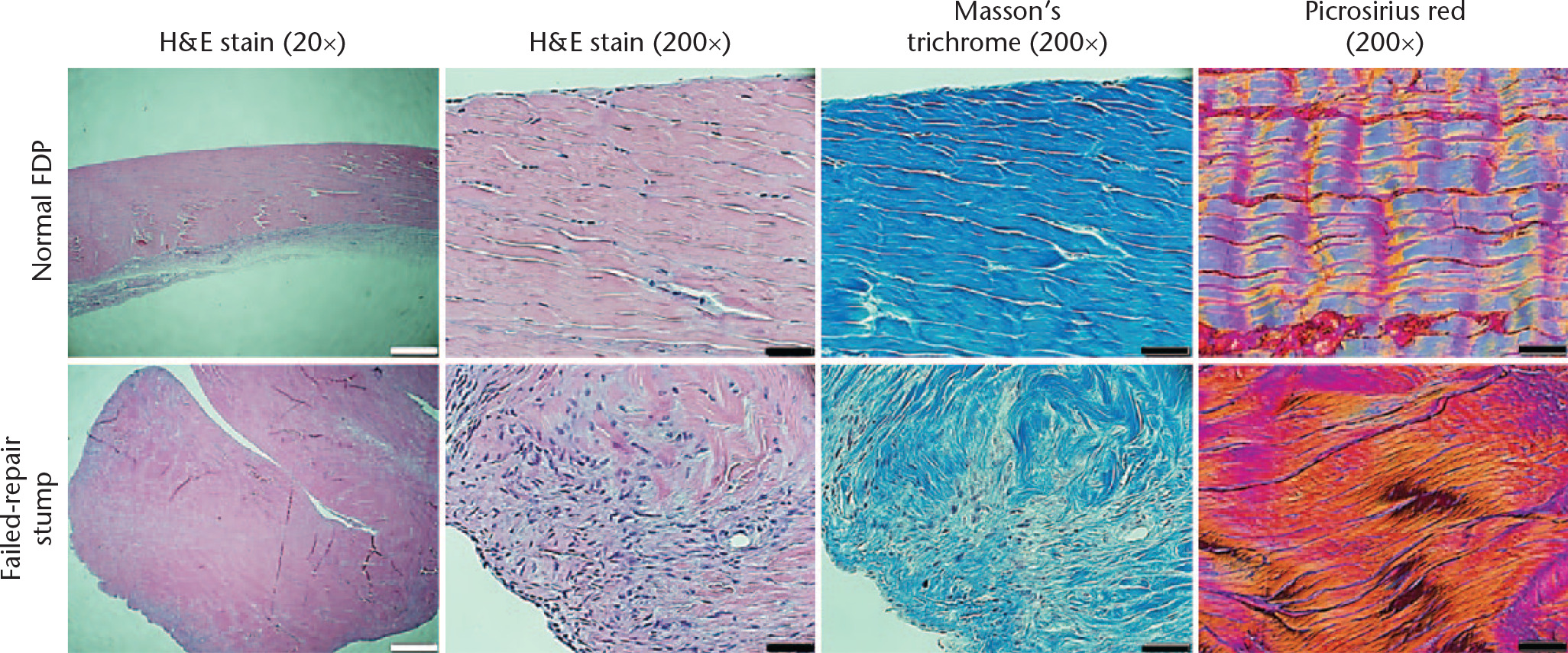 Fig. 3 
            Histological examination of failed-repair stumps and normal tendons. Histological staining with haematoxylin and eosin (H&E) and Masson’s trichrome showed non-parallel, crumpled collagen fibres with cell accumulation in the failed-repair stump compared with the normal tendon with parallel collagen and few cells embedded. In addition, the irregular collagen arrangement in the stump tendon was confirmed by Picrosirius red staining. White bars = 500 μm; black bars = 50 μm. FDP, flexor digitorum profundus.
          