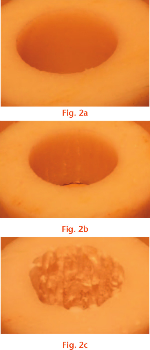 Fig. 2 
            Internal surface preparation: a) control; b) burr; and c) Orthosonics System for Cemented Arthroplasty Revision (OSCAR).
          