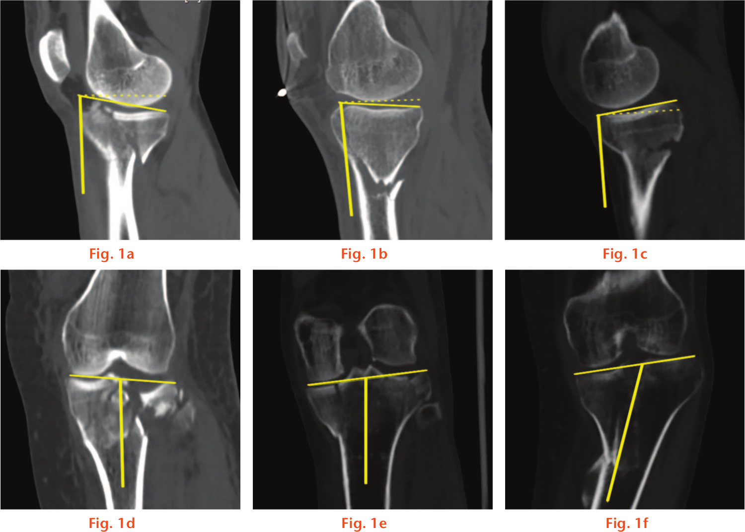 Fig. 1 
            Parameters in CT reconstruction images for injury mechanism. a) to c): Posterior tibial slope angle (PTSA), defined as the angle created by the tibial plateau and the long axis of the tibia in the sagittal plane. a) The increased PTSA indicates a flexion mode of initial position of knee joint; b) the normal or unchanged PTSA indicates extension injury pattern; c) the decreased PTSA (or retroversion) means the injured knee in hyperextension pattern. d) to f): tibial plateau angle (TPA) defined as the angle created by the medial angle of tibial plateau surface and the long axis of the tibia shaft in the coronal plane. d) The increased TPA indicates a valgus force; e) the normal or unchanged TPA indicates axial force; f) the decreased TPA means a varus force.
          