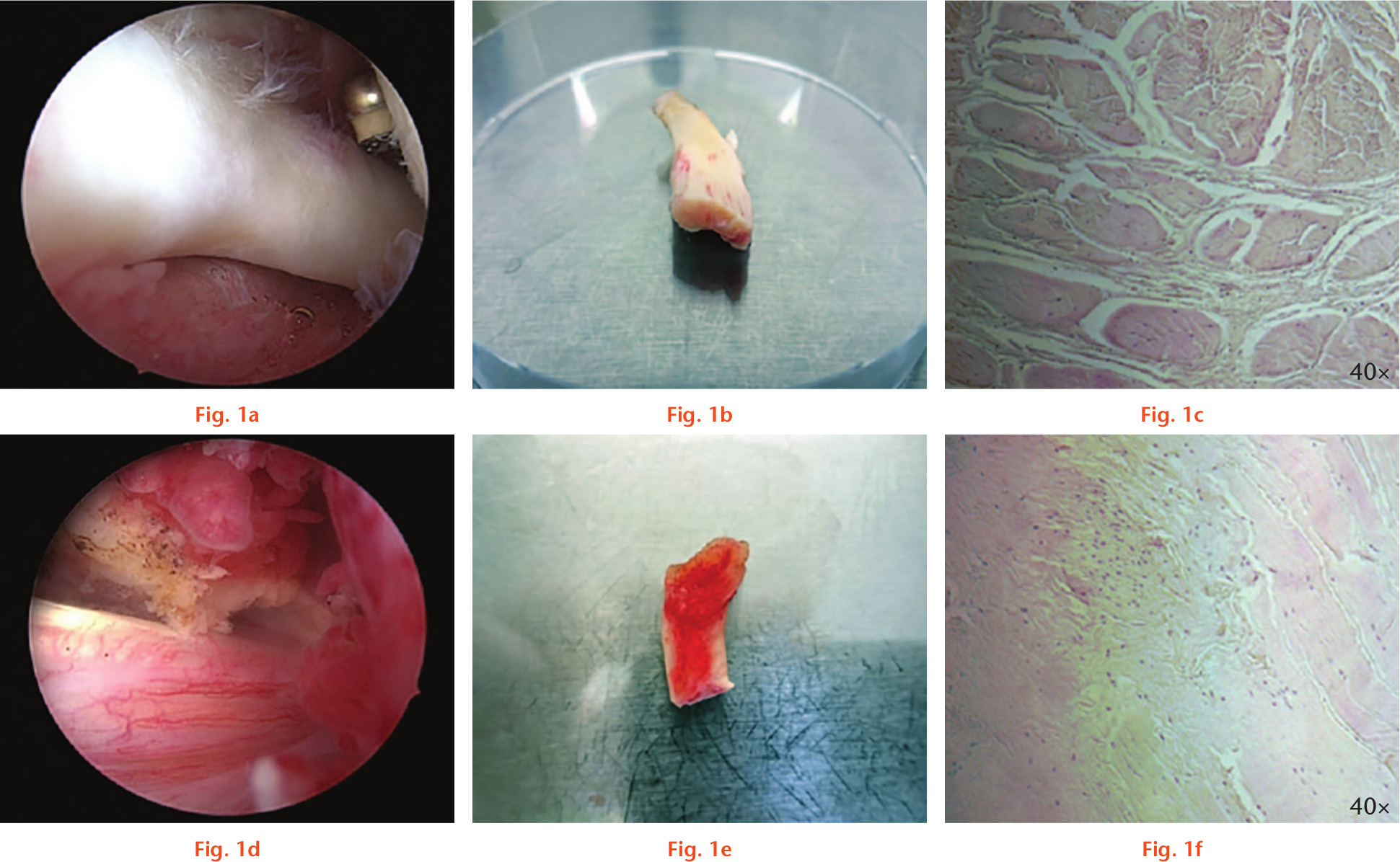 Fig. 1 
            Macroscopic and microscopic view of inflamed and non-inflamed tendon samples. Long head of the biceps (LHB) tendon samples with (d, e, f) and without (a, b, c) tendinitis are shown. a) and d) Intraoperative arthroscopic view. b) and e) Tendon samples before processing in the laboratory in a 10 cm petri dish. c) and f) Microscopic appearance with haematoxylin and eosin (H&E) stain. Images are taken at 40× as indicated.
          