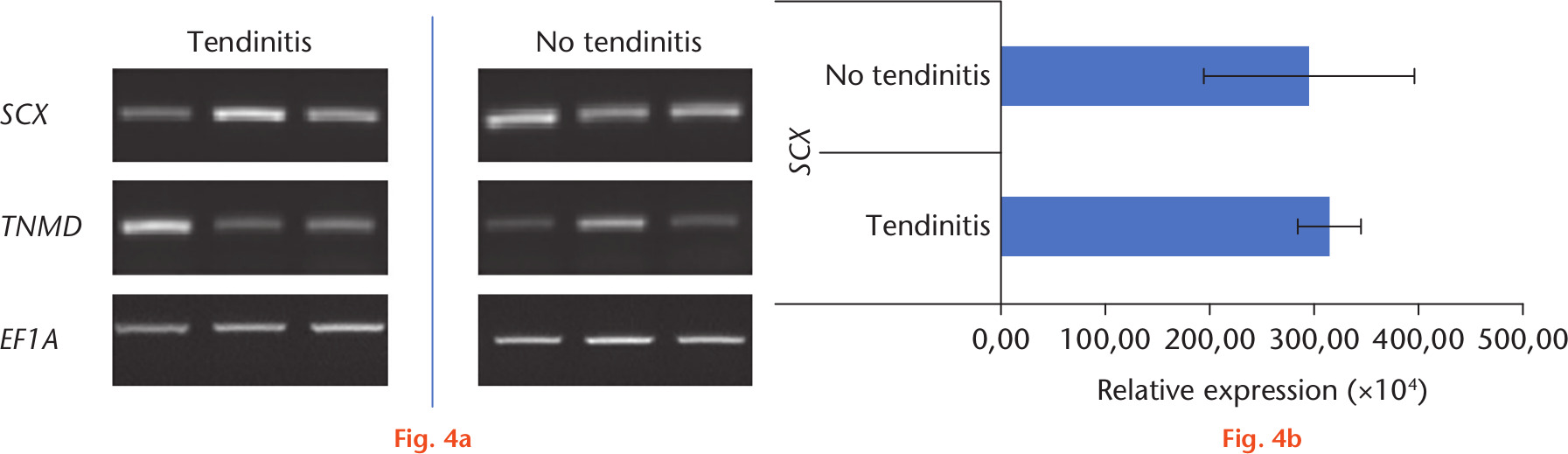 Fig. 4 
            a) Real-time-polymerase chain reaction (RT-PCR) and b) quantitative real-time-polymerase chain reaction (qRT-PCR) analyses of inflamed and non-inflamed tendon samples. Expression patterns of scleraxis (SCX) and tenomodulin (TNMD) in long head of the biceps (LHB) samples with and without tendinitis. For RT-PCR, elongation factor 1α (EF1A), and for qRT-PCR, ribosomal protein S27a (RPS27A) served as housekeeping genes for normalization of the expression values. A total of six donors were included.
          
