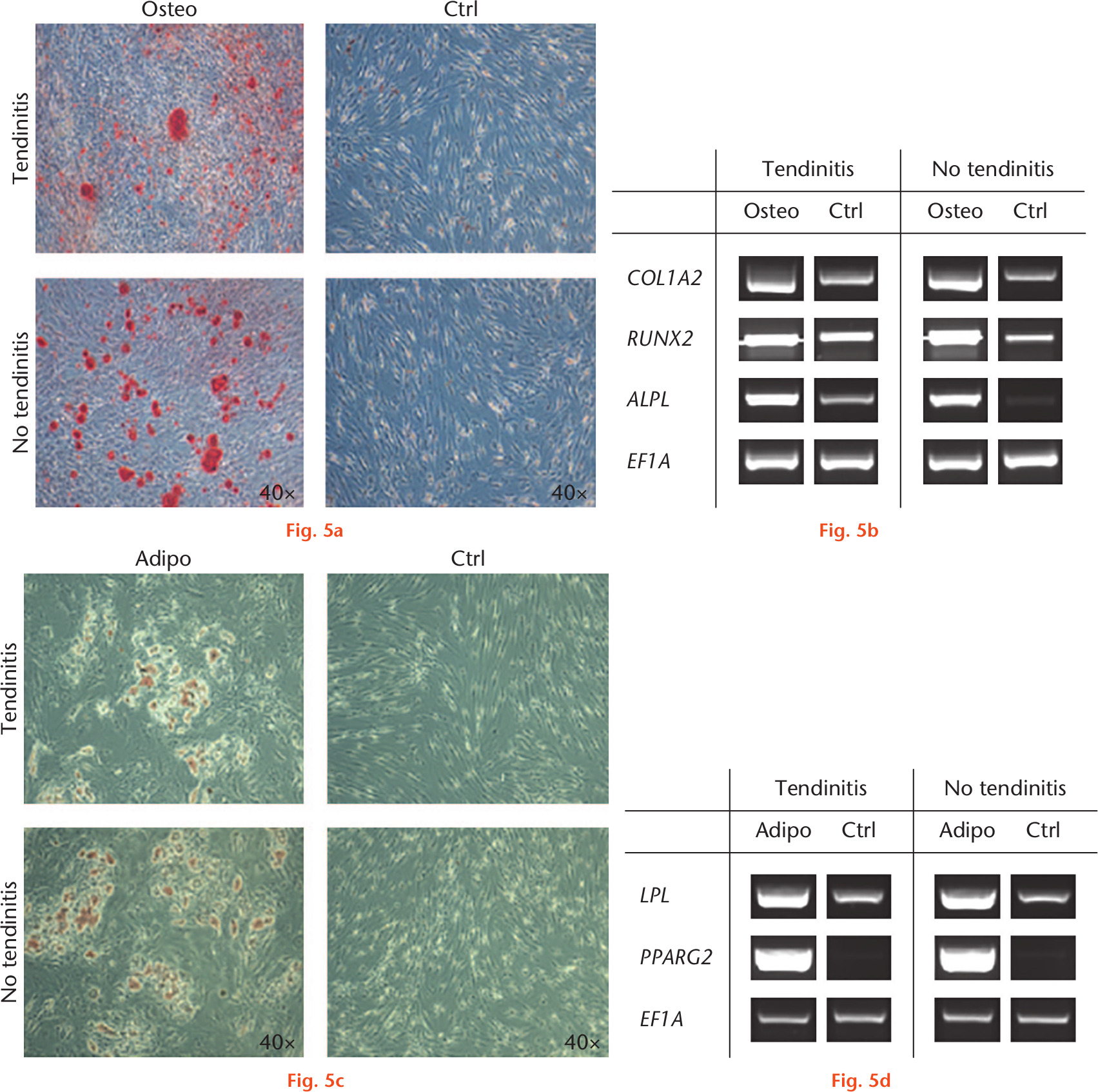Fig. 5 
            Osteogenic and adipogenic differentiation of cells isolated from inflamed and non-inflamed long head of the biceps (LHB) samples at four weeks. a) Cultures treated with osteogenic supplements produced a mineralized extracellular matrix as shown by intense staining for Alizarin Red. Control cultures did not produce a mineralized matrix. b) Real-time polymerase chain reaction (RT-PCR) revealed that cultures of both groups expressed the runt-related transcription factor 2 (RUNX2), alkaline phosphatase (ALPL), and collagen type I alpha 2 (COL1A2) in response to osteogenic stimuli compared with controls. c) Cells cultivated in adipogenic medium showed formation of lipid droplets in both groups as determined by Oil red O staining. Cultivation in control medium, in contrast, did not result in droplet enrichment. d) Expression of the adipogenic marker genes lipoprotein lipase (LPL) and peroxisome proliferator-activated receptor gamma 2 (PPARG2) was increased in both groups treated with adipogenic medium, but was not detectable in cells cultivated with control medium. The housekeeping gene elongation factor 1α (EF1A) showed equal expression levels in all groups. Six donor samples were tested, and representative images from three different donors are shown. Osteo, osteogenic; Adipo, adipogenic; Ctrl, control.
          