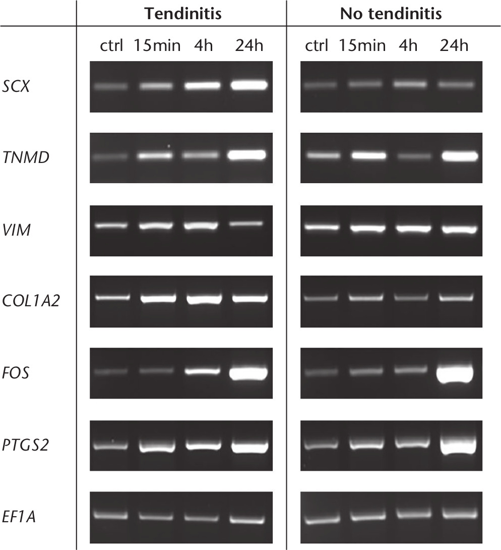 Fig. 7 
            Tenogenic differentiation of cells isolated from inflamed and non-inflamed tendon samples. Real-time polymerase chain reaction (RT-PCR) analysis after cyclic stretching of cells isolated from inflamed and non-inflamed long head of the biceps (LHB) samples for 15 minutes, four hours, and 24 hours. After cyclic stretching, cells of the two groups showed a time-dependent increase in the expression of both tenogenic and mechanoresponsive genes. Tendogenesis-related genes including scleraxis (SCX), tenomodulin (TNMD), vimentin (VIM), and collagen type 1 alpha 2 (COL1A2) were examined, while prostaglandin-endoperoxide synthase 2 (PTGS2) and Fos proto-oncogene, AP-1 transcription factor subunit (FOS) served for the analysis of mechanosensitivity. The expression of elongation factor 1α (EF1A) was included as an internal control for RNA loading. A total of six donors were included.
          