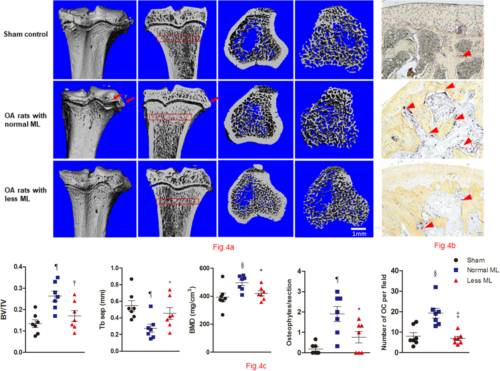 Fig. 4 
            Less mechanical loading (ML) reduced abnormal bone remodelling in subchondral bone in an osteoarthritis (OA) rat. a) Micro-CT of the tibia subchondral bone of rats showed that OA rats with less ML displayed decreased bone mineral density (BMD) and increased trabecular separation (TbSp), compared with OA rats with normal ML. b) The osteophytes were counted in three sections of each rat, and findings revealed that the mean number of osteophytes per joint in the less ML group was significantly lower than that of the normal ML group (red arrows). In addition, OA rats with less ML also showed a significantly lower number of osteoclasts (OCs) per bone volume, compared with the normal ML group (red arrowheads). c) Furthermore, quantitative analysis showed that OA rats with less ML had significantly lower bone volume/tissue volume (BV/TV) and BMD, and greater TbSep, which was seen in the subchondral bone 200 μm to 400 μm below the growth plate (red boxes in a). Scale bar: 1 mm. Values are presented as mean and standard error of the mean (SEM). One-way analysis of variance (ANOVA) was used, *p < 0.05; †p < 0.01; ‡p < 0.001, between OA rats with normal and less ML. §p < 0.01; ¶p < 0.001, between sham controls and OA rats with normal ML. Magnification of Fig. 4b: 200×.
          
