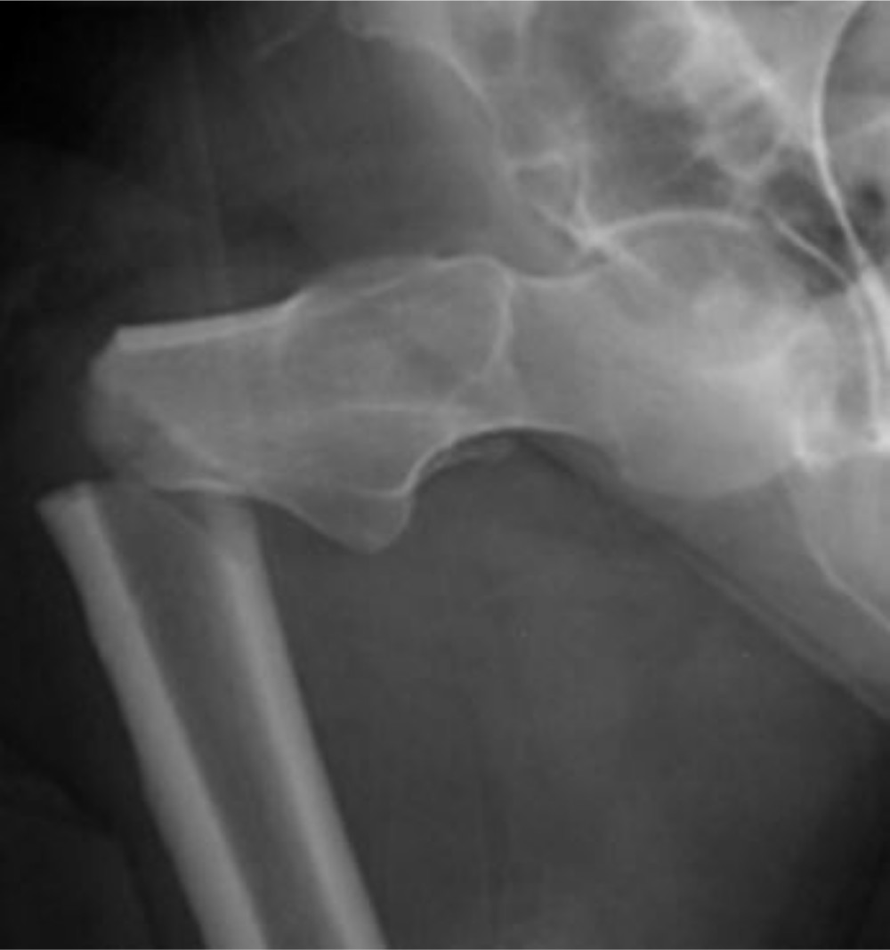 Fig. 4 
          Anteroposterior radiograph of an atypical femoral fracture caused by the prolonged use of bisphosphonates. Figure is reproduced from Lloyd et al.32
        
