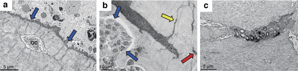 Fig. 5 
          Bacterial attack on bone via the osteocyte lacunocanalicular network. a) and b) show transmission electron microscopy (TEM) images of the cortical bone from a mouse model of implant infection created using Staphyloccocus aureus. S. aureus develops an attack front to eradicate the bone lining cells (blue arrows) and embedding the osteocyte (OC). After compromising the cortical bone, the bacteria then colonize the osteocyte lacunocanalicular network (yellow arrow) and migrate within the canaliculi by expanding the structure to reach other osteocytes (red arrow in Fig. 5b). They simultaneously demineralize the bone matrix. c) An osteocyte lacuna inhabited by infiltrating S. aureus bacteria. Marker bars are: a) 5 μm (6,000× magnification); b) 10 μm (1,800× magnification); and c) 2 μm (12,000× magnification). Image is reproduced from Masters et al.53
        
