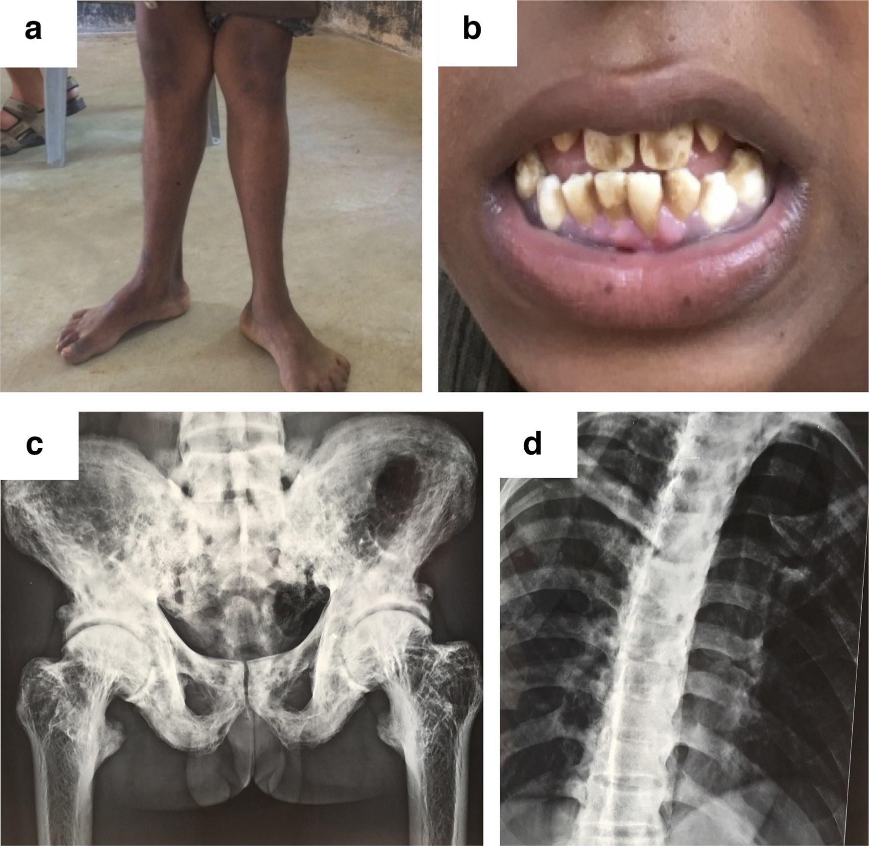 Fig. 6 
            Anteroposterior radiographs showing the skeletal effects of fluoride poisoning through drinking water in humans. a) Knee deformity in a 12-year-old boy and b) fluoride-induced discolouration of teeth. c) and d) show radiographs of patients exposed to high fluoride levels showing dense sclerotic pelvic bone and spine. Unpublished images used with permission from Prof. Urban Rydholm, Lund University Hospital, Lund, Sweden.
          