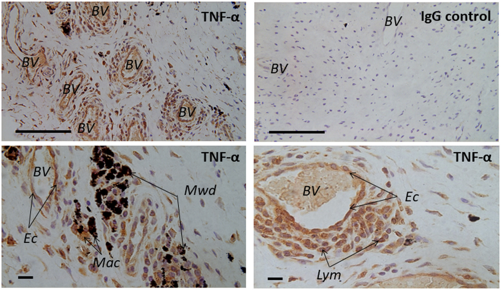 Fig. 1 
            Light microscopic images displaying hip capsular tissue from patients who underwent revision surgery for a failed hip arthroplasty. Tissues were stained for tumour necrosis factor-alpha (TNF-α) using anti-TNFα antibody, as part of the immunohistochemical staining (see Table I for more details of this antibody). Note the strong immunoexpression in the revision samples containing metal wear products. TNF-α-expressing cells were identified as macrophages (Mac), lymphocytes (Lym), and endothelial cells (Ec) lining the blood vessels (BV). No specific staining was detected in the isotypic controls. IgG, immunoglobulin G; Mwd, metal wear debris. Scale bars: upper panel = 100 μm, lower panel = 10 μm.
          