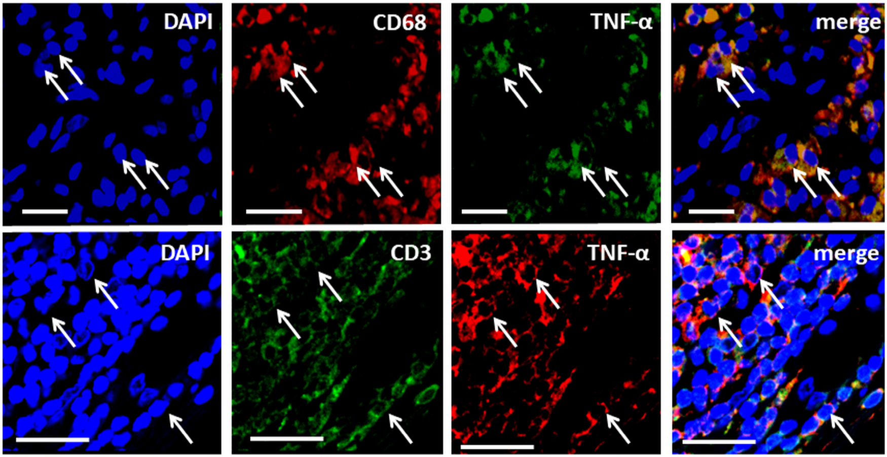 Fig. 2 
            Double-immunofluorescence demonstrating colocalization of tumour necrosis factor-alpha (TNF-α) with the macrophage marker Cluster of Differentiation 68 (CD68) (upper panel) and the pan T-cell marker Cluster of Differentiation 3 (CD3) (lower panel). Nuclei are stained with 4′,6-diamidino-2-phenylindole (DAPI). Scale bars = 50 μm.
          