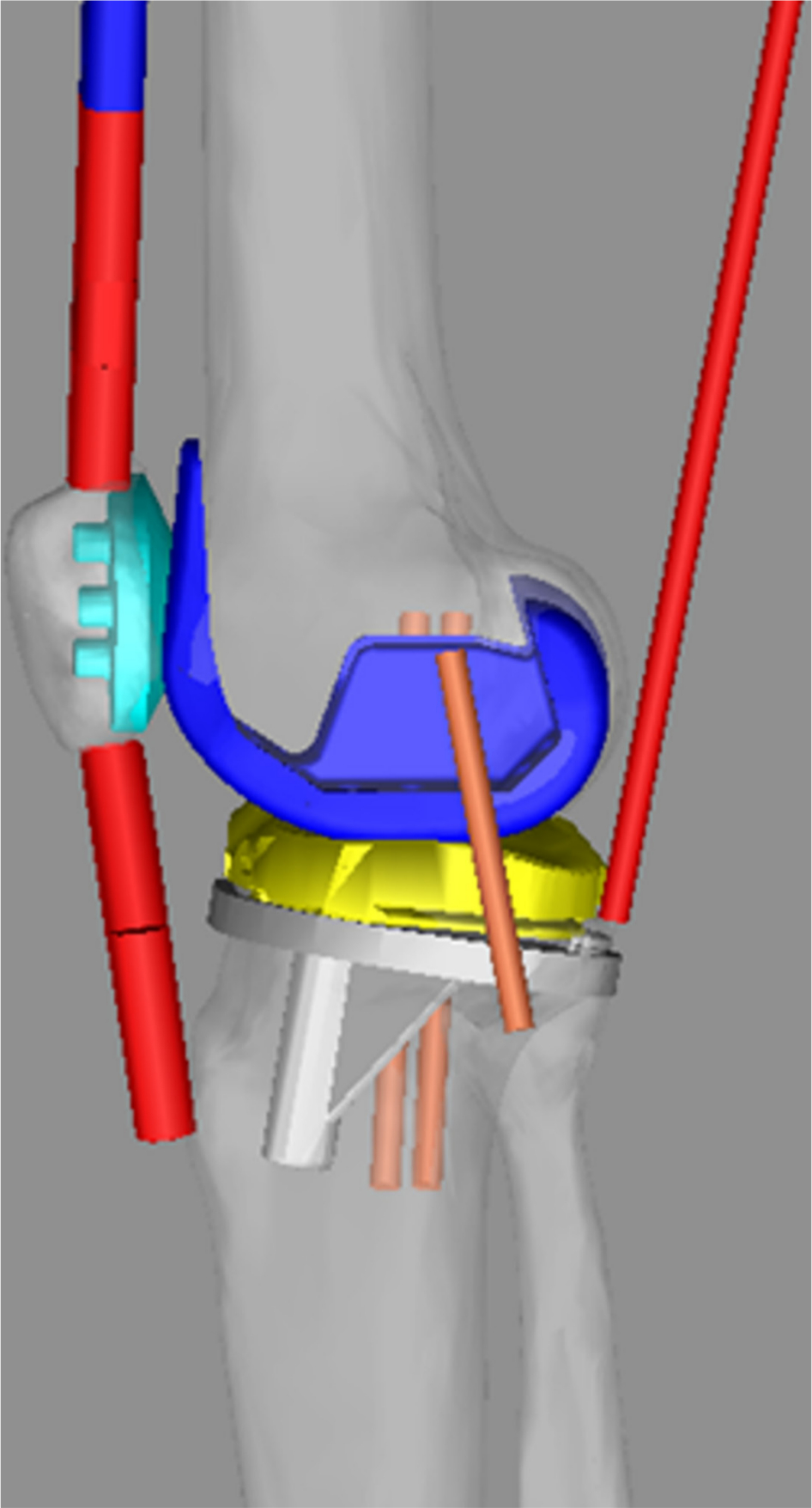 Fig. 1 
            Postoperative knee model imported into the LifeMOD/KneeSIM 2010 (lateral view).
          