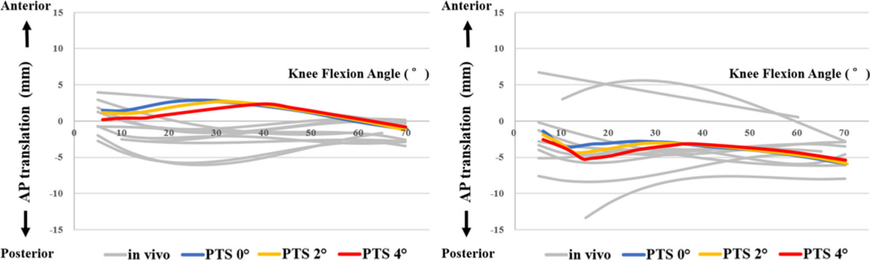 Fig. 5 
            Medial femoral condylar lowest point (CLP) (left) and lateral femoral CLP (right) of the femoral component relative to the tibial insert during stair climbing from 70° to 10° of knee flexion based on simulated and in vivo data in bi-cruciate stabilized (BCS) total knee arthroplasty (TKA). AP, anteroposterior; PTS, posterior tibial slope.
          
