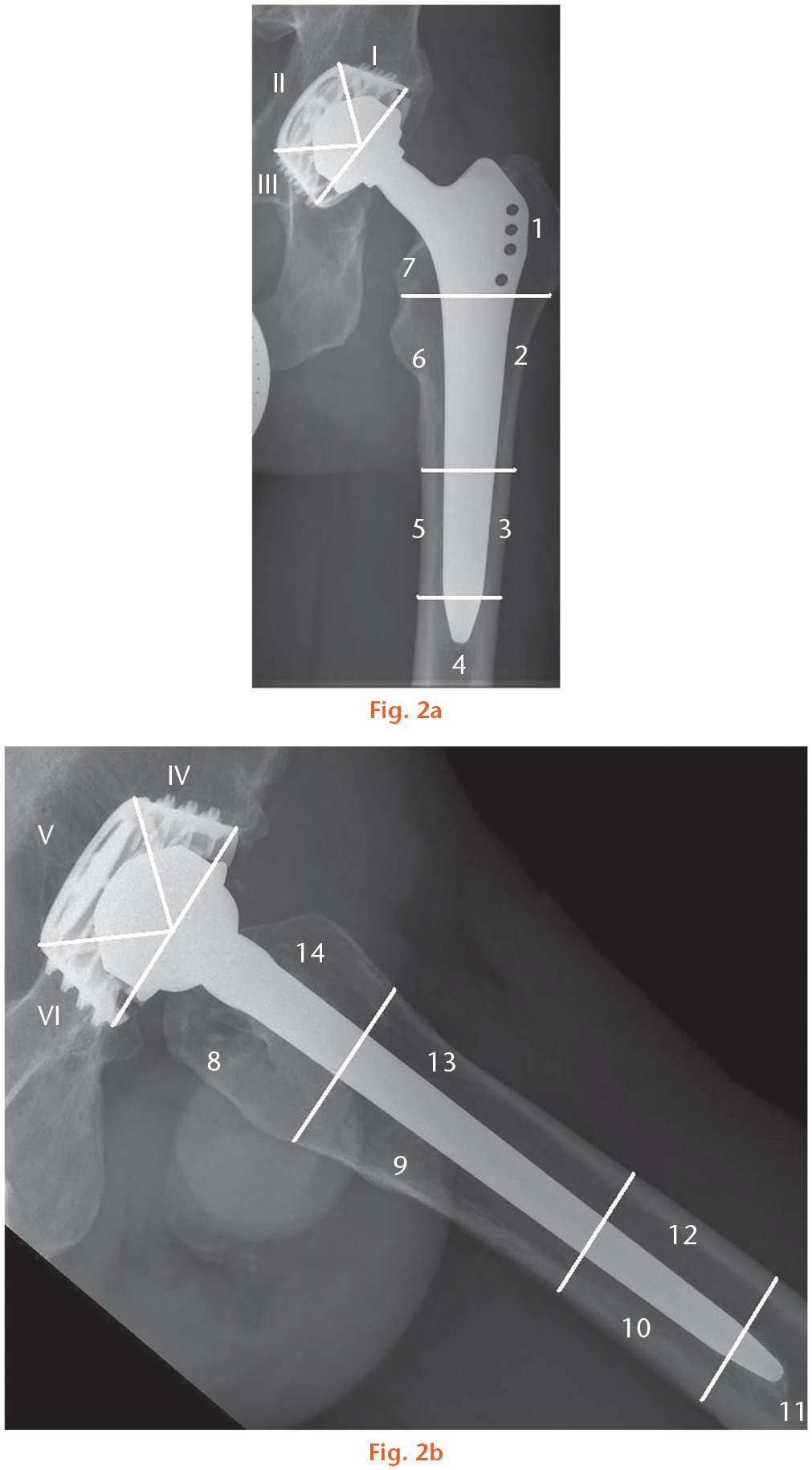 Fig. 2 
          a) Distribution of radiolucent lines and osteolytic lesions observed on an anteroposterior radiograph of the femoral component (Gruen zones, 1 to 728) and the cup (DeLee classification, I to III23) of a 56-year-old male patient at the last follow-up at 20 years. b) Distribution of radiolucent lines and osteolytic lesions observed on a lateral radiograph of the femoral component (Gruen zones, 8 to 1428) and the cup (DeLee classification, IV to VI23) of a 56-year-old male patient at the last follow-up at 20 years.
        