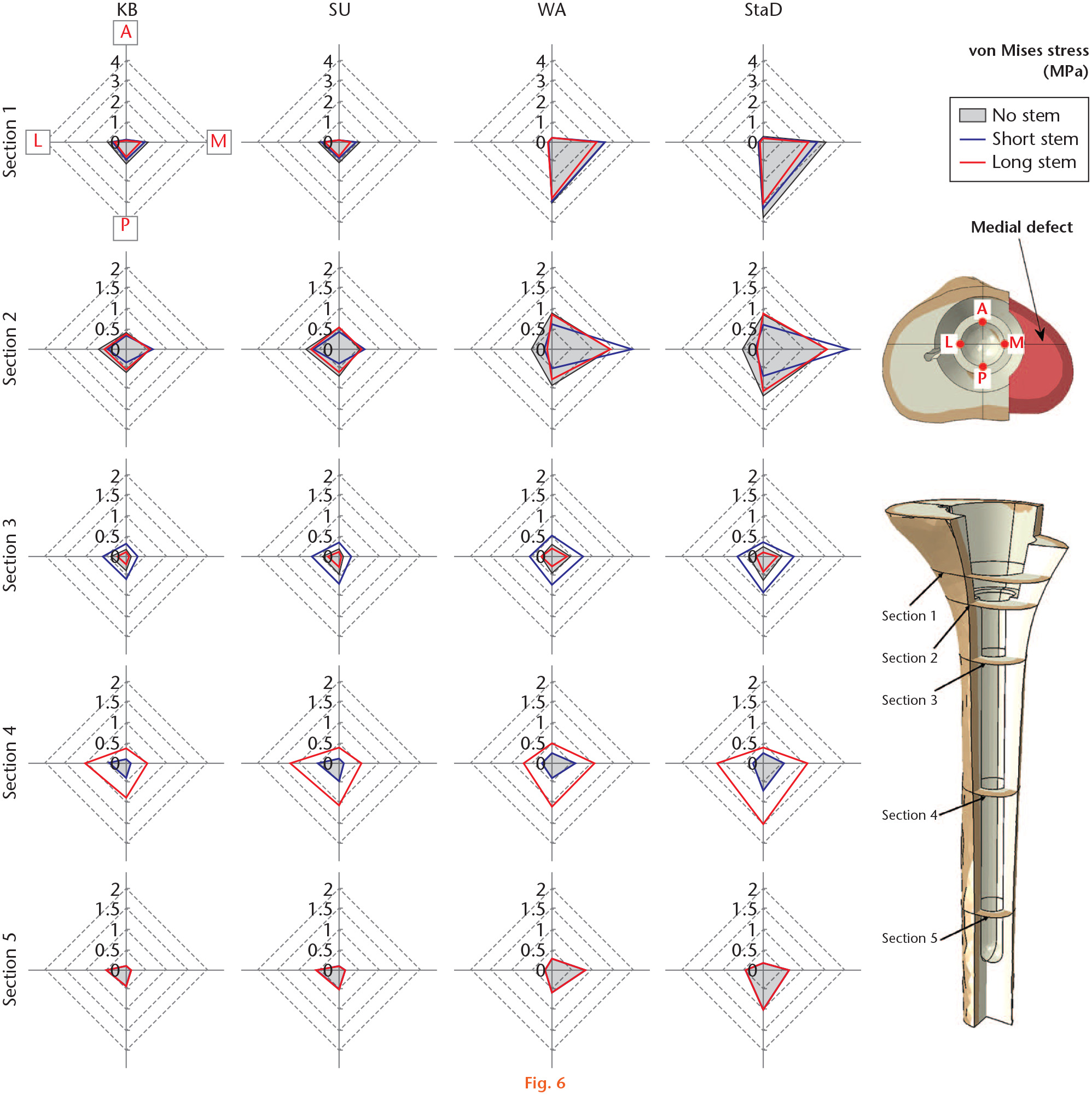 Fig. 6 
            von Mises stress of medial defected bone from four anatomical points (anterior: A, lateral: L, medial: M, and posterior: P) when the cone was used for revision total knee arthroplasty with no stem, a short stem, or a long stem. Four loading scenarios were considered: knee bend (KB), standing up (SU), walking (WA), and stairs descending (StaD).
          