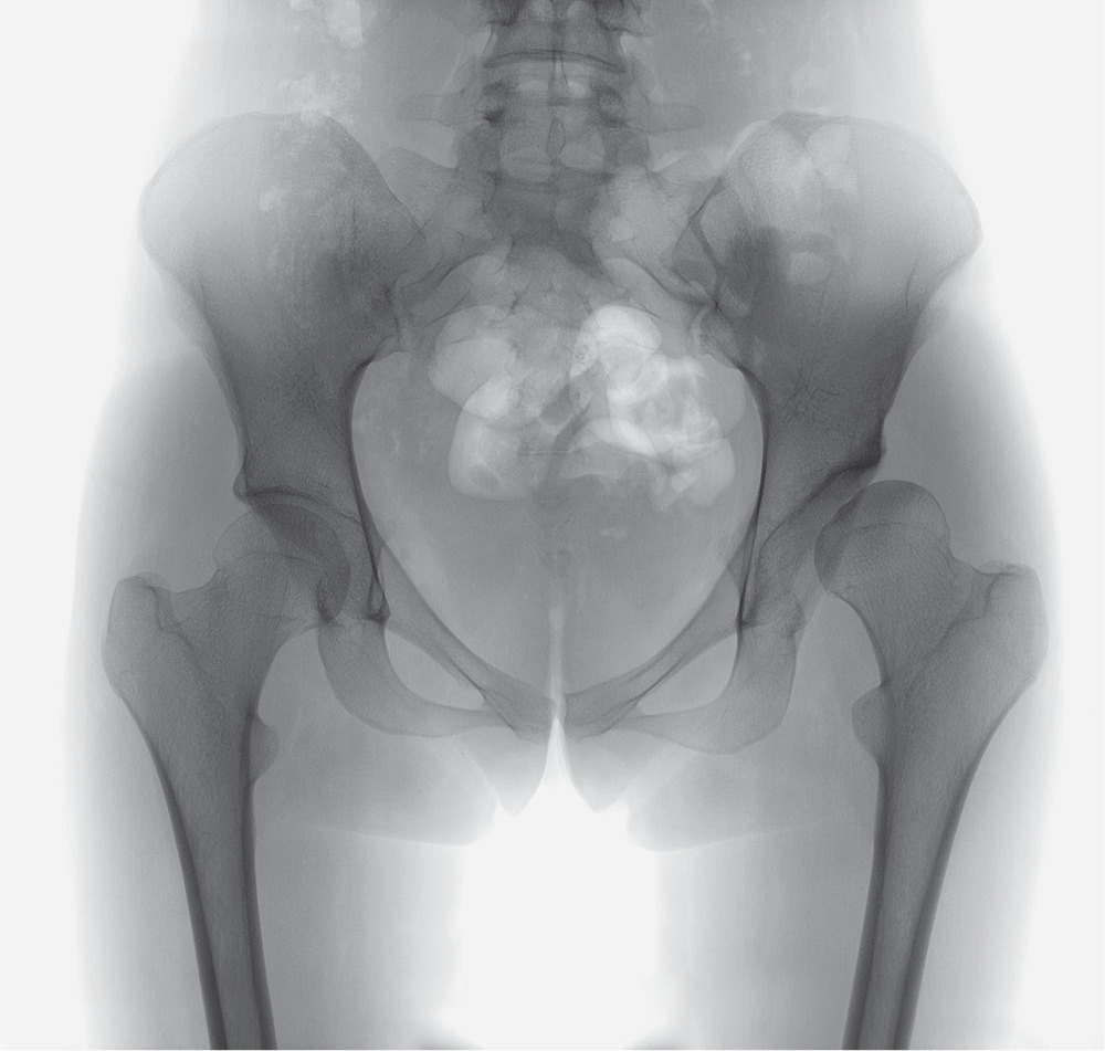 Fig. 4 
          Preoperative anteroposterior radiographs of a 22-year-old female with a normal right hip with lateral centre edge angle (LCEA) of approximately 28° and acetabular index (AI) of approximately 2.
        