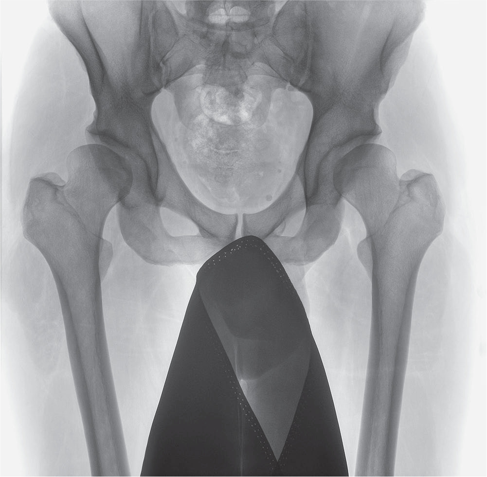 Fig. 5 
          Preoperative anteroposterior radiographs of a 24-year-old male with a globally/laterally deficient right hip with a lateral centre edge angle (LCEA) of approximately 5° and an acetabular index (AI) of approximately 20.
        