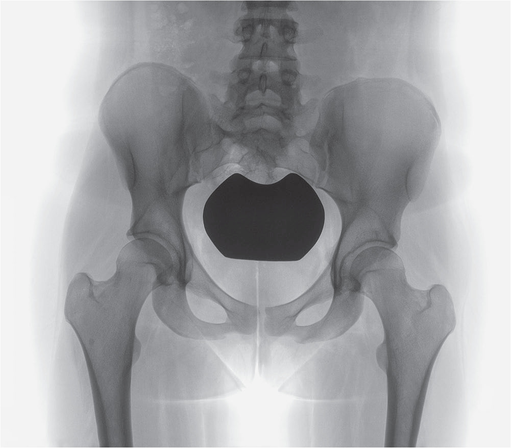 Fig. 6 
          Preoperative anteroposterior radiographs of a 21-year-old female with a posteriorly deficient left hip with a lateral centre edge angle (LCEA) of approximately 30° and an acetabular index (AI) of approximately -2.
        