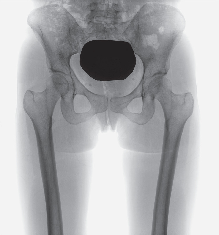 Fig. 7 
          Preoperative anteroposterior radiographs of a 19-year-old female with an anteriorly deficient right hip with a lateral centre edge angle of approximately 22° and an acetabular index of approximately 7.
        