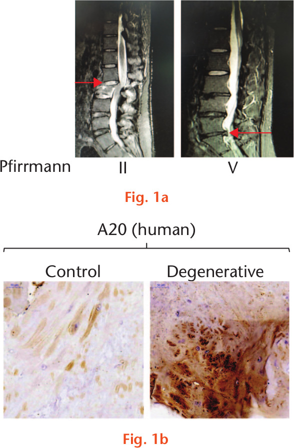 Fig. 1 
            The expression of A20 is increased in the degenerated human intervertebral disc. a) Representative MRI images of two different intervertebral discs in patients from the normal group (spine fracture, Pfirrmann II, one 35-year-old male; as indicated by red arrow) and degeneration group (Pfirrmann V, five male patients aged 35 to 40 years, as indicated by red arrow). b) The expression of A20 from intervertebral discs in patients was analyzed by immunohistochemical staining. Magnification: 127 mm × 35 mm (300 × 300 DPI).
          