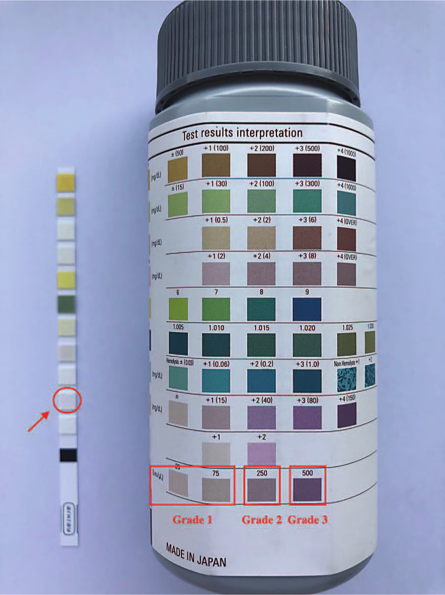 Fig. 1 
          Definitions of colour grades. The arrow points to the area where one drop of synovial fluid was applied. The results were read based on the change in the strip pad colour after approximately three minutes. We divided the results into three grades: Grade 3 (dark purple, “500”, equal to + +) was positive, Grade 2 (light purple, “250”, equal to +) was intermediate, and Grade 1 (other colours) was negative.
        