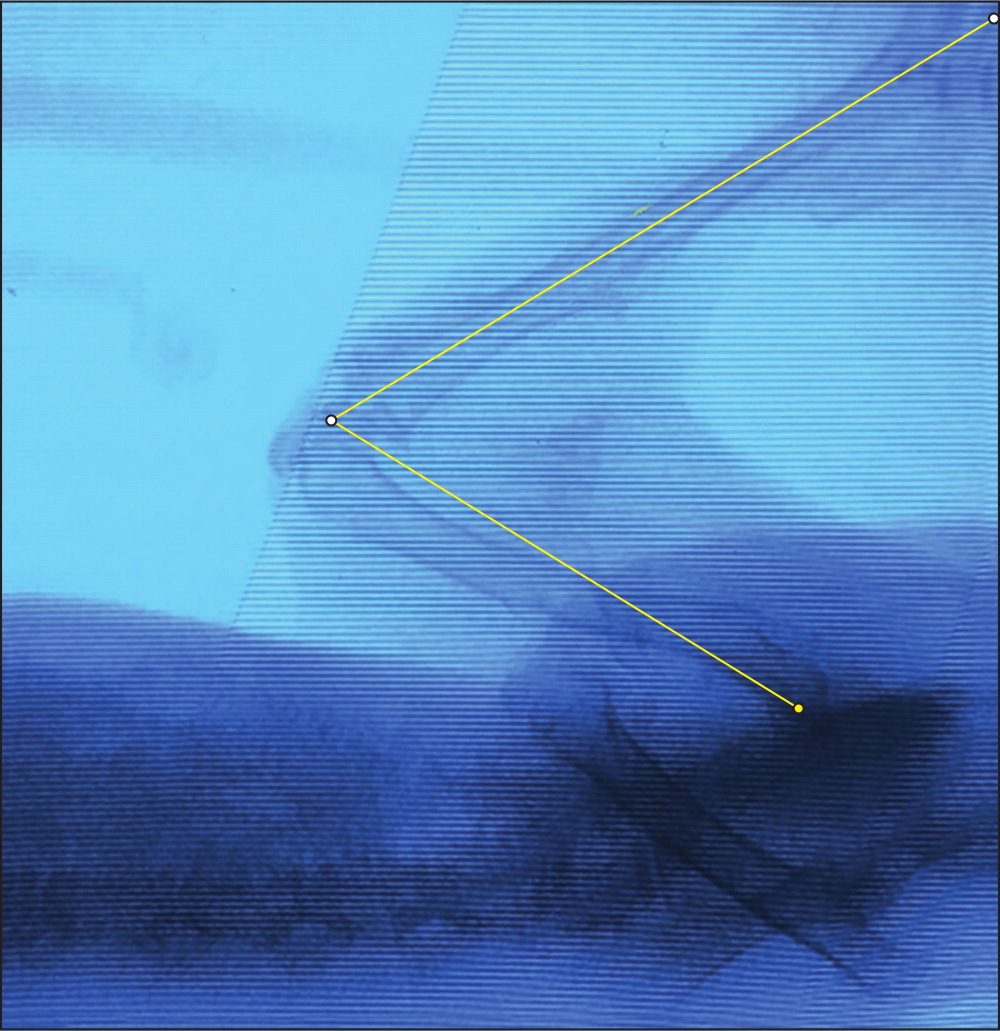 Fig. 1 
            In live rabbits, the passive extension angle was measured using fluoroscopic imaging. The angle formed at the centre of the knee joint (parallel to the transepicondylar axis) was measured using a line bisecting the tibial shaft and a line along the posterior femoral cortex centred at the hip joint.
          