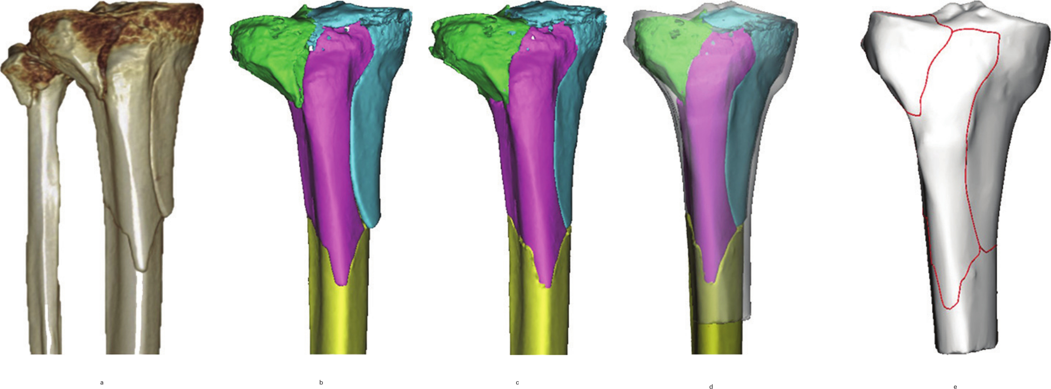Fig. 1 
            The method used for the mapping of tibial plateau. a) 3D image of tibial plateau fracture in CT scans. b) Major fragments were reconstructed in Mimics (Materialise, Leuven, Belgium). c) Virtual reduction. d) Reduced fragments were adjusted to match the template in 3-matic 10.0 software (Materialise). e) Fracture lines were delineated on the template.
          