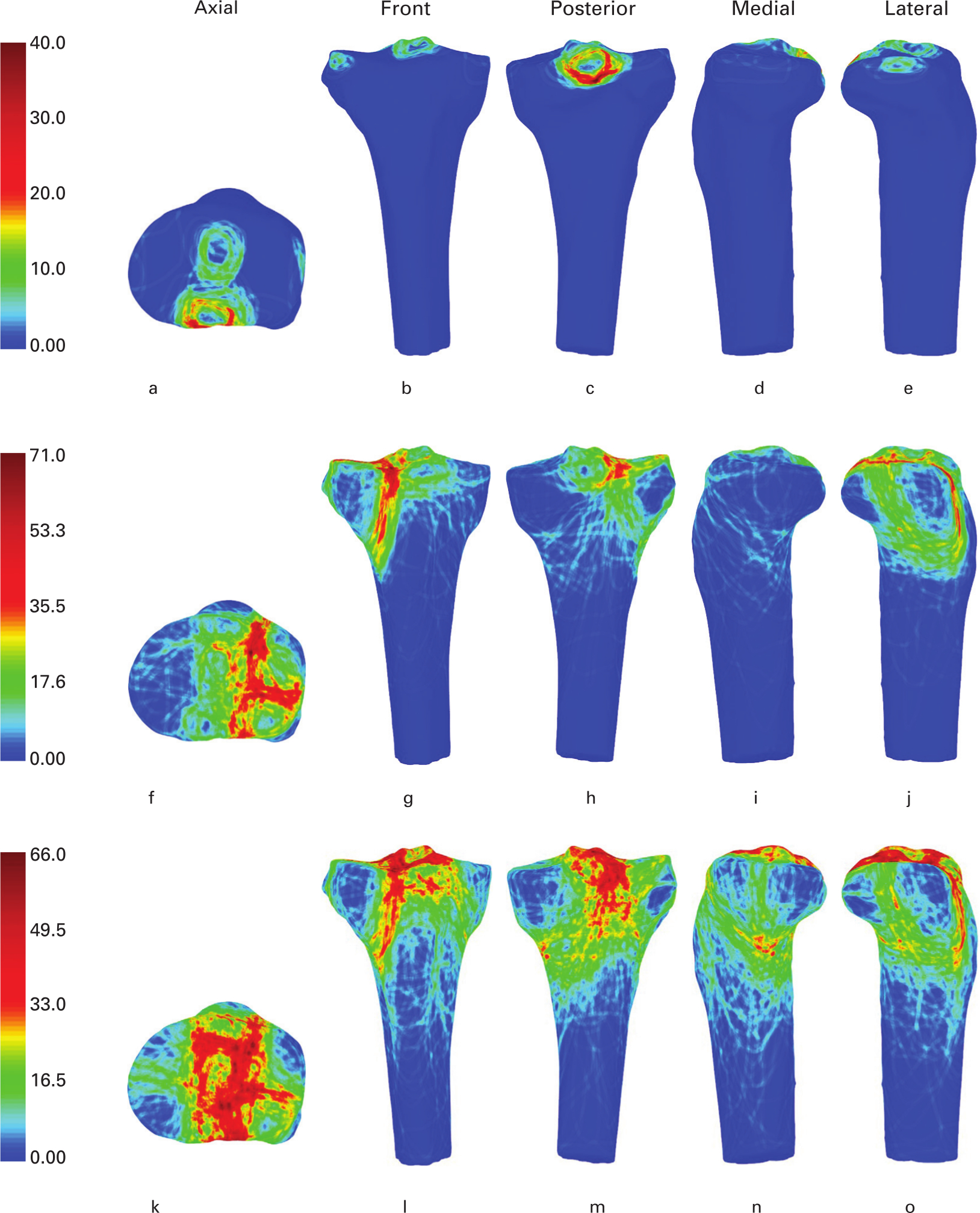 Fig. 5 
            Representative views of the 3D heat mapping of fracture lines according to the Orthopaedic Trauma Association/AO Foundation (OTA/AO): a) to e) type A; f) to j) type B; and k) to o) type C. These include the axial, front, posterior, medial, and lateral views. Red colour represents higher frequency of fracture line density.
          