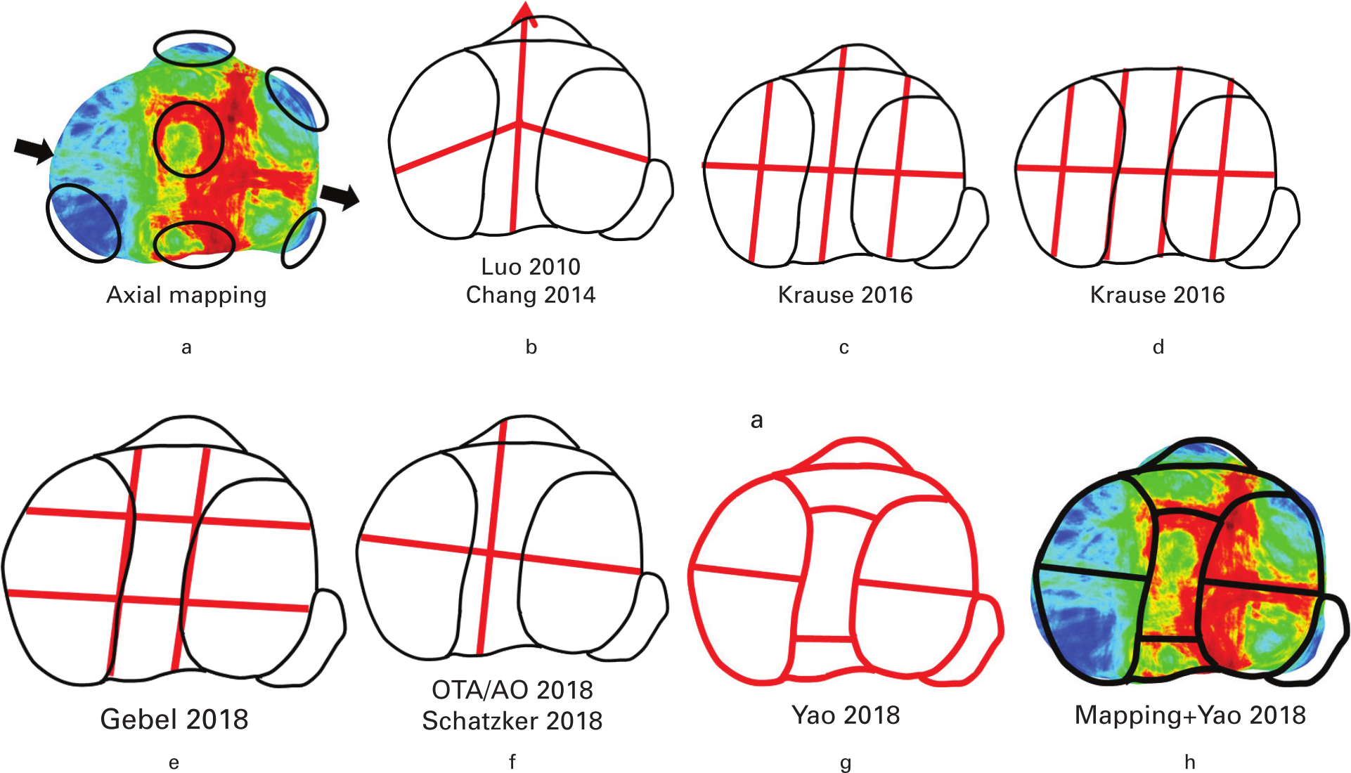 Fig. 6 
          Comparison of multiple classifications according to the heat mapping in the axial plane. a) Axial mapping. The black arrow shows the trajectory extended from the anteromedial to the posterolateral site. b) Three-column concept and four quadrants. c) Eight segments. d) Ten segments. e) Nine segments. f) Orthopaedic Trauma Association/AO Foundation (OTA/AO) 2018 and Schatzker 2018. g)17 h) Axial mapping and Yao 2018.
        