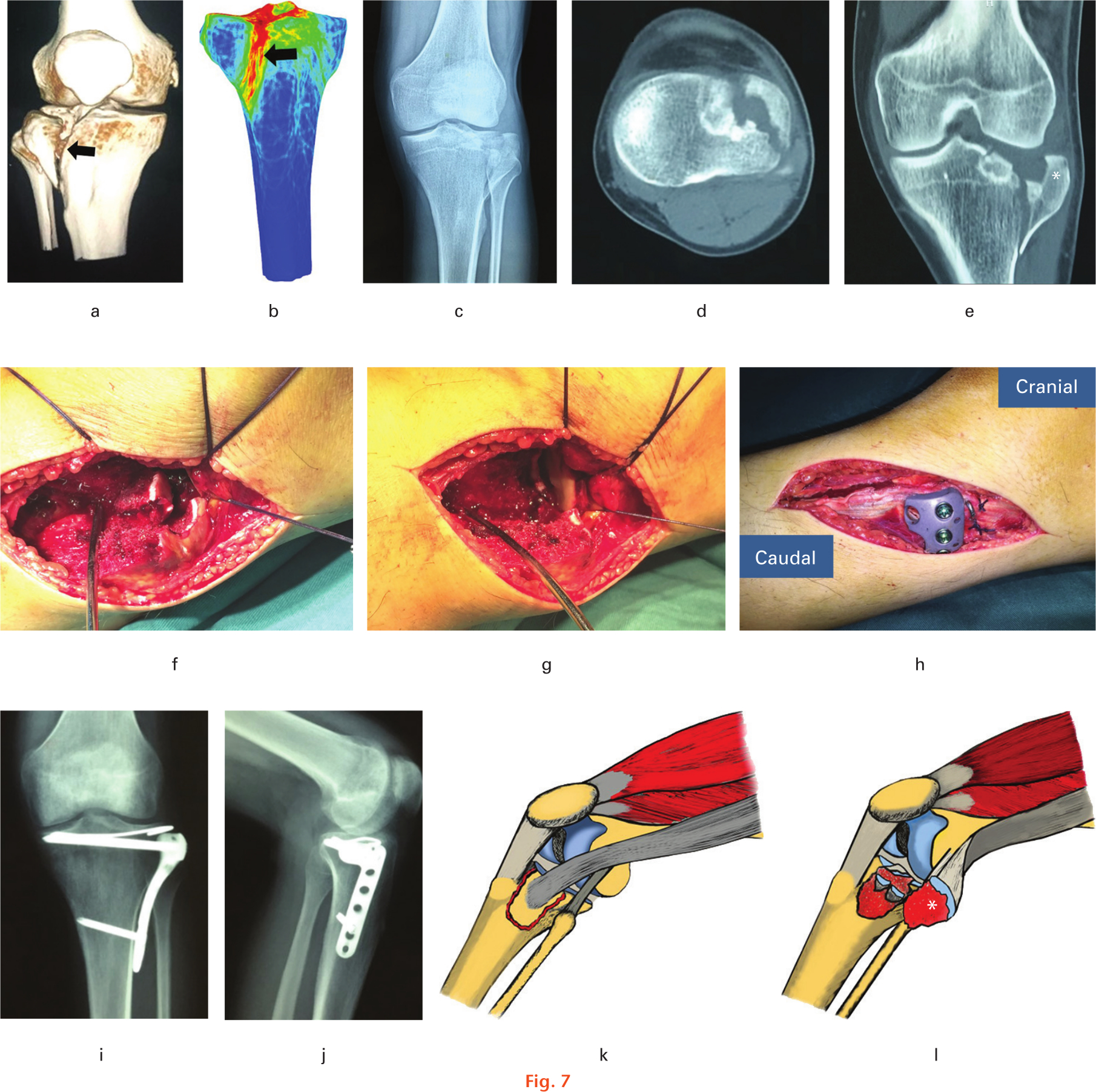 Fig. 7 
          The articular surface was reduced through the fracture gap, preserving the bone-tendon interface between the iliotibial band (ITB) and Gerdy’s tubercle. a) and b) The hot zone of fracture lines passing Gerdy’s tubercle and the bare area/tibial tubercle. The black arrow represents the trajectory. c) Preoperative radiograph. d) and e) Preoperative CT scans. f) and g) Exposure and reduction through the fracture gap. h) The insertion of the ITB was intact after the plate placement. i) and j) Postoperative radiographs. k) and l) The illustrations display the extorsion of Gerdy’s tubercle fragment with the ITB. *The Gerdy’s tubercle fragment.
        