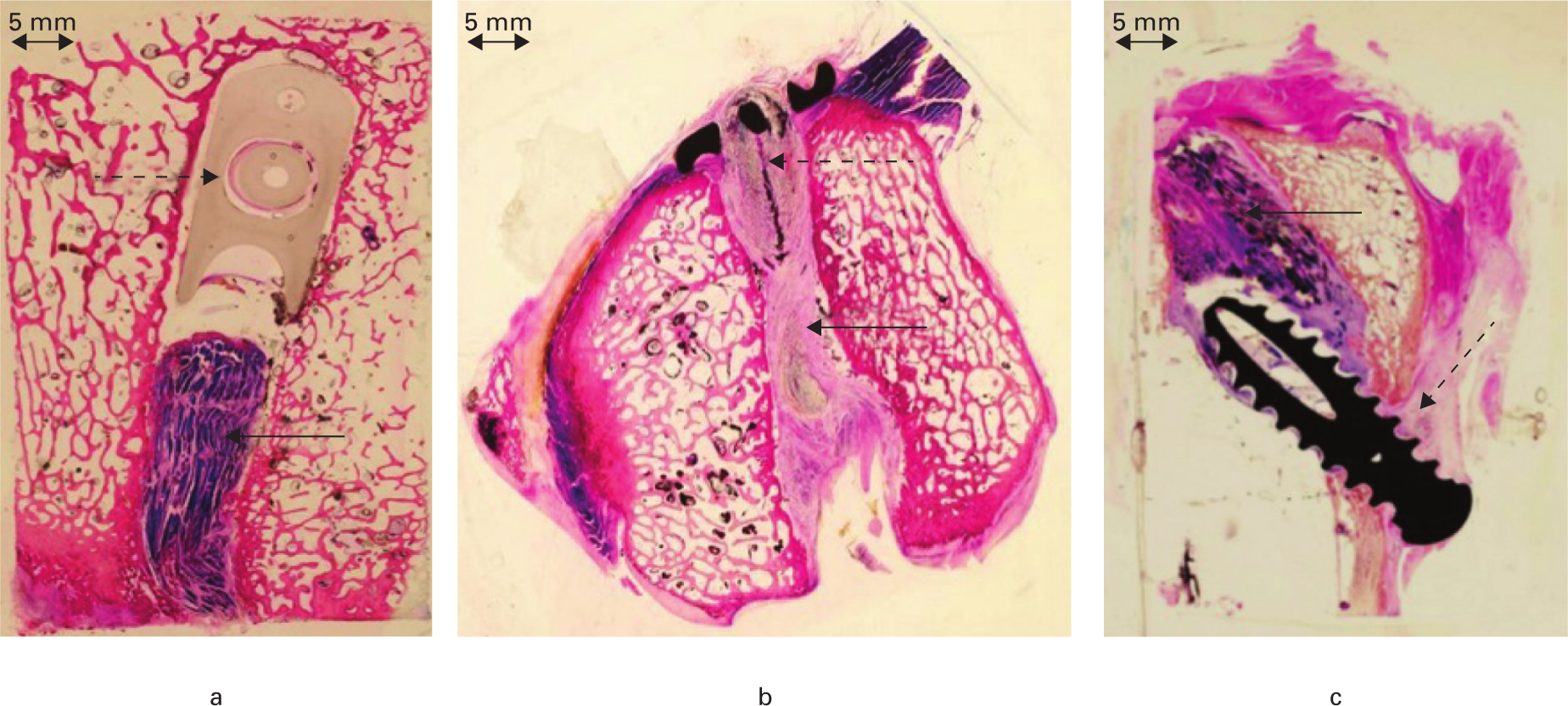 Fig. 5 
            Histological sections of the bone tunnels: a) femoral tunnel with Stratis ST cross-pin fixation (dashed arrow) and porcine superflexor tendon (pSFT) xenograft (arrow); b) femoral tunnel with Endobutton fixation (dashed arrow) and pSFT graft (arrow); c) tibial tunnel with soft screw fixation (dashed arrow) and pSFT graft (arrow) (stained with Toluidine Blue and Paragon; magnification ×1.25).
          