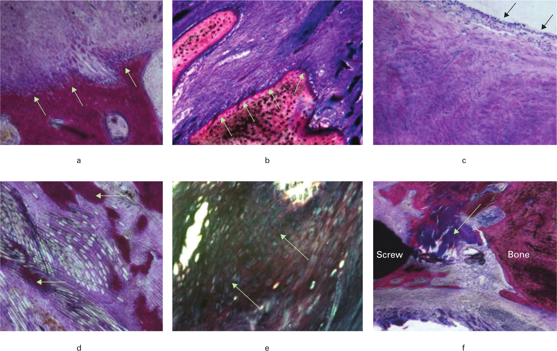 Fig. 6 
            Histological findings in the bone tunnels: a) ×100 magnification showing Sharpey's fibres in the femoral tunnel; b) ×100 magnification showing Sharpey's fibres near the tip of tibial screw; c) ×100 magnification showing a synovial membrane-like sheath over remodelled tissue emerging from tibial tunnel; d) ×100 magnification showing bone penetration within Endobutton loop fibres; e) ×200 magnification showing chondrocyte-like cells in the graft distal to the cross-pin device; f) ×100 magnification showing tendon mineralization and ossification between the soft screw and bone tunnel (stained with Toluidine Blue and Paragon).
          