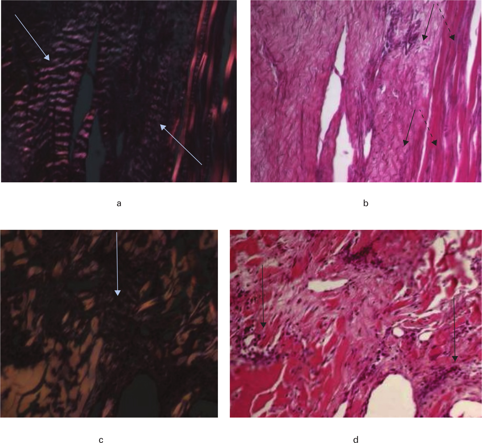 Fig. 7 
            Histological appearance of the intra-articular graft at 200× magnification. a) In the Endobutton group under polarized light, clear evidence of ligament-like crimped collagenous tissue is seen (arrow); b) in the Endobutton group using light microscopy an intimate association between new remodelled tissue (black arrow) and residual porcine tendon scaffold (dashed arrow) is observed; c) in the cross-pin group under polarized light, relatively little crimp-like organization (arrow) is seen; d) in the cross-pin group using light microscopy, highly cellular regions (arrow) were observed (stained with Toluidine Blue and Paragon).
          