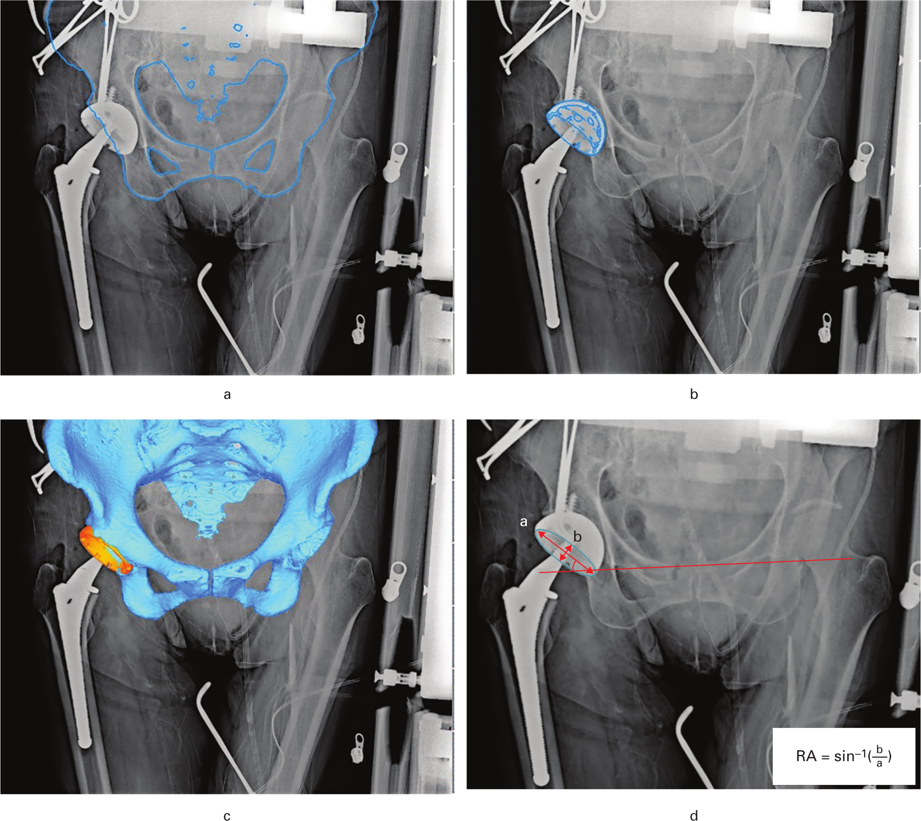 Fig. 2 
            a) The edge of the 3D pelvic bone model is image-matched to the perioperative pelvic radiograph using the image-matching software (JointTrack; University of Florida, Gainesville, Florida, USA). b) The edge of the 3D acetabular component is image-matched. c) 3D view of the pelvic bone model and the acetabular component. d) The radiological anteversion angle (RA) was calculated with the formula reported by Lewinnek et al,8 and the radiological inclination angle (RI) was measured as the angle between the line connecting both tear drops (solid line) and the long axis of the acetabular component (red arrow indicating “a”).
          