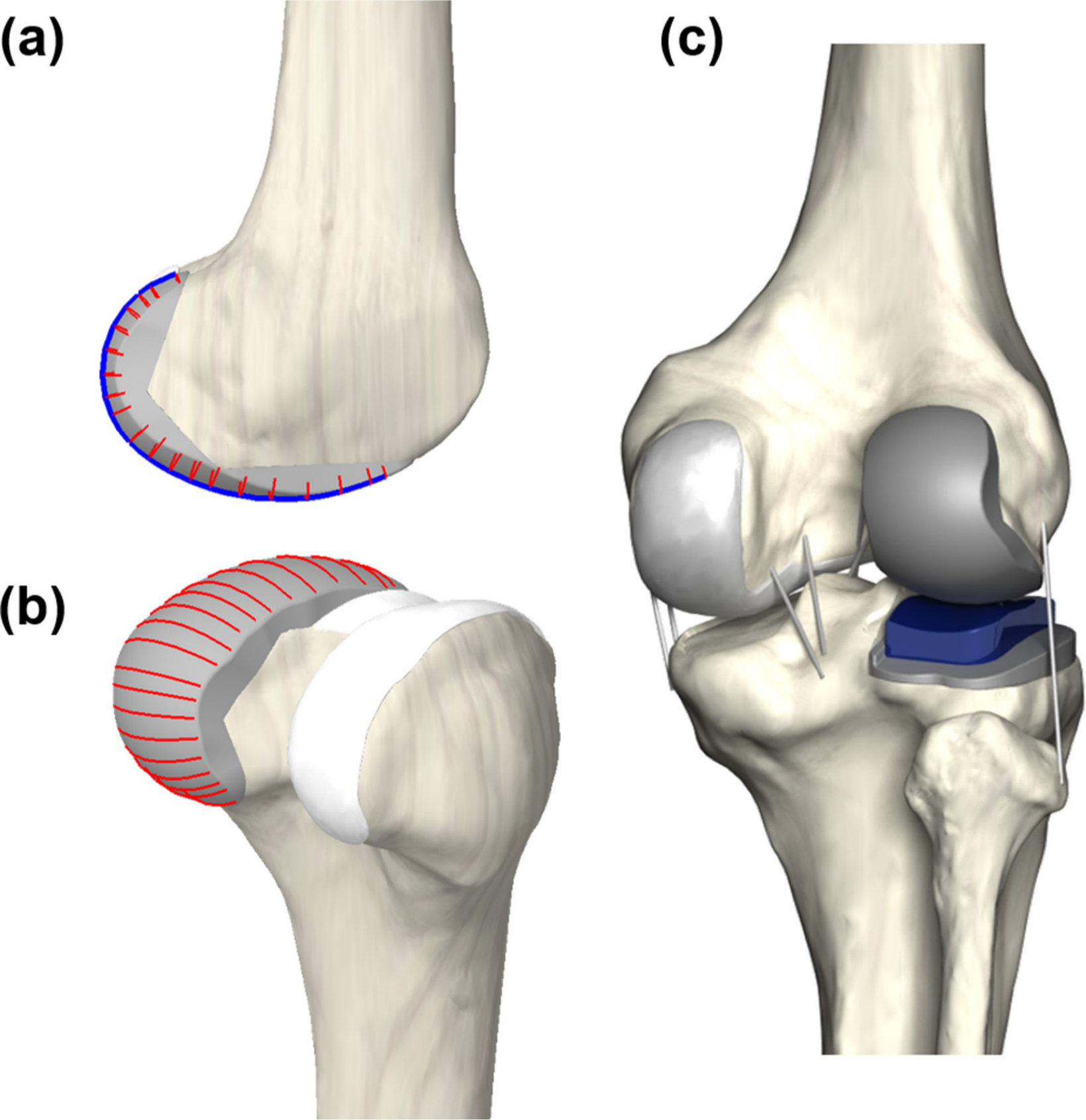 Fig. 1 
            Design process of patient-specific unicompartmental knee: a) spline curves used to model the femoral component; b) polyethylene insert that provides an anatomical fit and a perfect coverage; and c) patient-specific unicompartmental knee arthroplasty (UKA) model design.
          