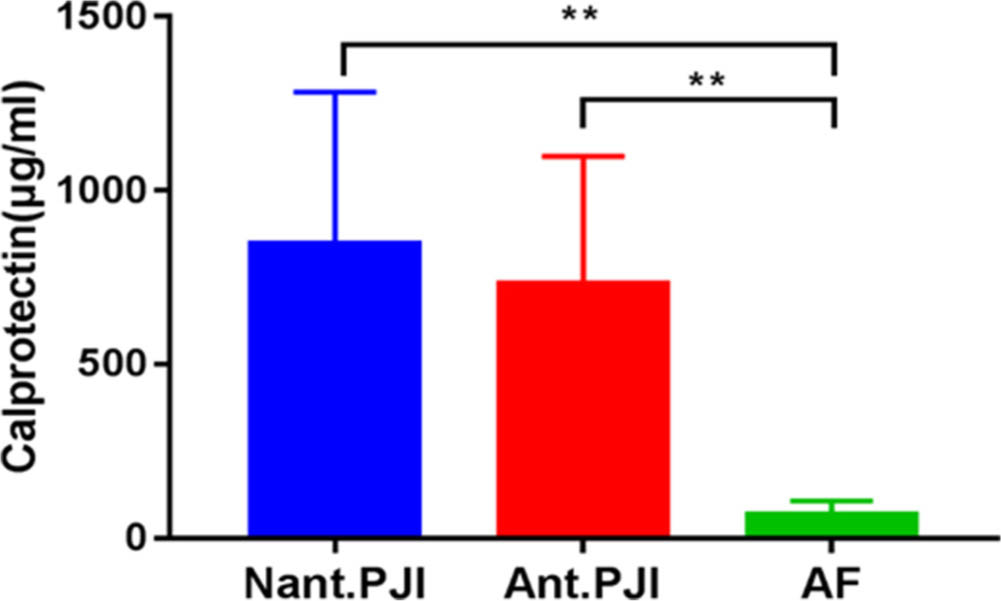 Fig. 3 
          The concentraction of calprotectin in the prosthetic joint infection (PJI) group was not affected by antibiotics treatment preoperatively, but both of them were higher than that of aseptic failure (AF) group.**p <0.01, Mann-Whitney U test. Ant., antibiotics; Nant., no antibiotics.
        