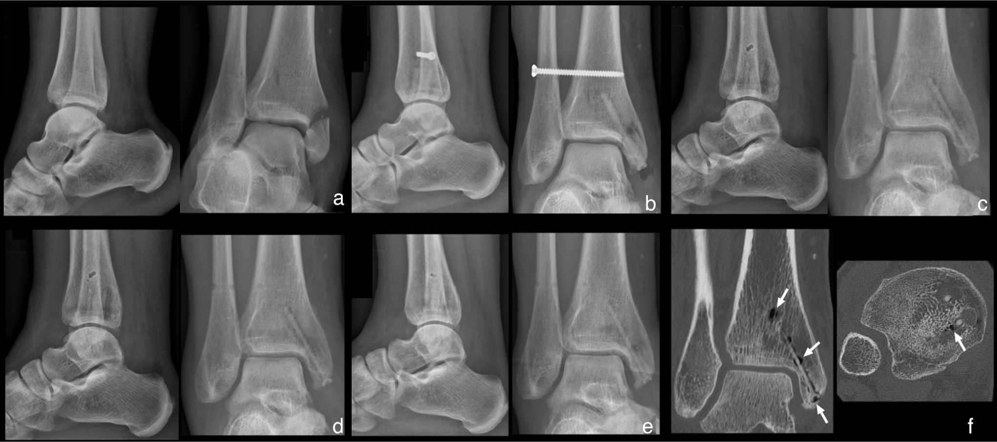 Fig. 3 
            a) Anteroposterior and lateral ankle radiographs of a 49-year-old female patient; medial malleolar fracture combined with distal tibiofibular joint disruption (Maisonneuve fracture). b) Two-week timepoint radiographs, anatomical reduction with two magnesium (Mg)-based screws and one titanium screw; visible fracture line at the medial malleolus, small signs of radiolucent zones within the bone surrounding the screws. c) Six-week timepoint, plane radiographs with complete fracture consolidation, increase of radiolucent zones within the bone surrounding the screws, removed titanium screw. d) Timepoint radiograph images at 12 weeks with constant radiolucent zones. e) Timepoint radiographs at 24 weeks. f) CT scan at 52 weeks, decrease of radiolucent zones, increased endosteal bone mass, and periosteal bone ingrowth at the screw head (white arrow).
          