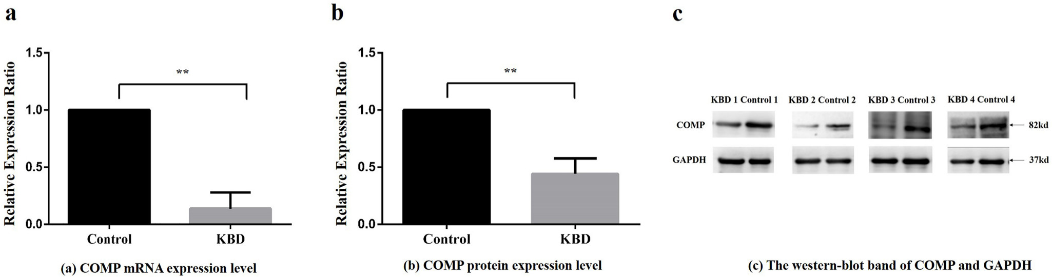 Fig. 1 
            Relative expression ratio of cartilage oligosaccharide matrix protein (COMP) in messenger RNA (mRNA) and protein scales between Kashin-Beck disease (KBD) patients and controls. a) Relative expression ratio of COMP mRNA between KBD patients and normal controls. Compared with the control group, **p < 0.01. b) Relative protein expression ratio of average integrated optical density (IOD) value extracted from western blot band of COMP between KBD patients and controls. IOD compared with the control group, **p < 0.01. c) The western blot band of COMP and reference protein glyceraldehyde-3-phosphate dehydrogenase (GAPDH) in four KBD patients and four control subjects.
          