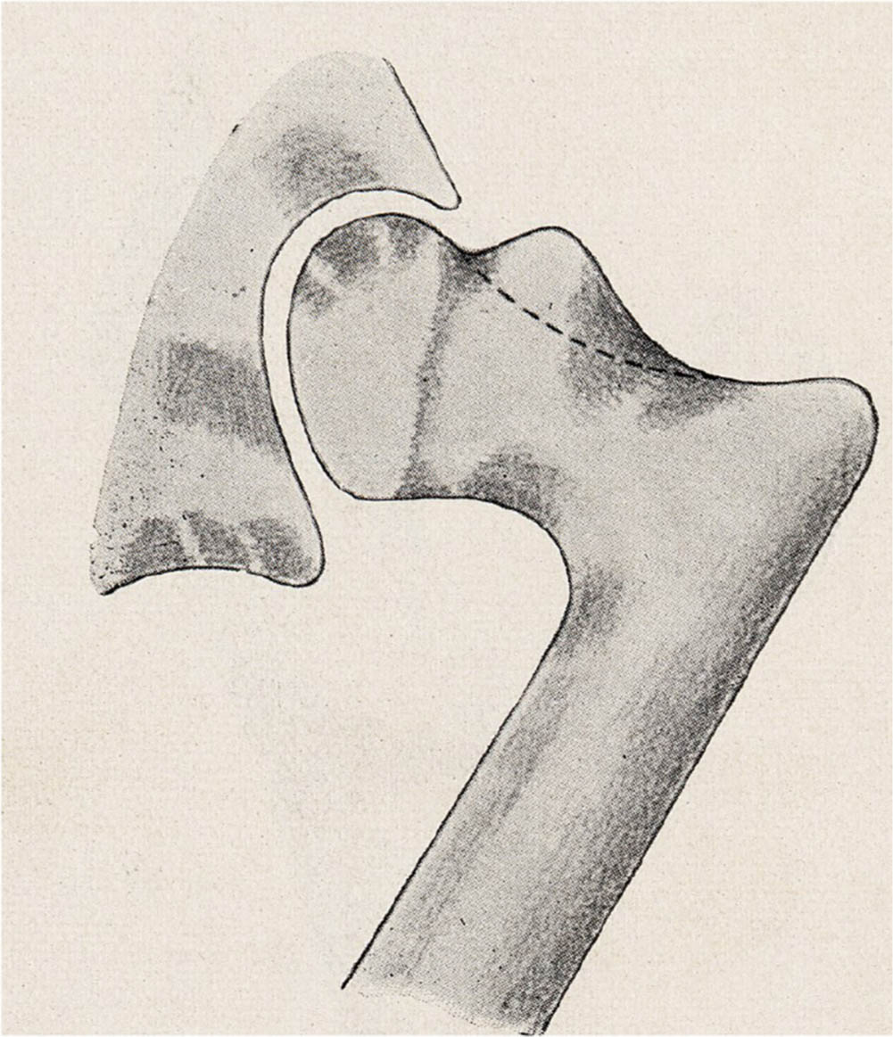 Fig. 2 
            Diagram illustrating the ‘bump’ causing the impingement. The dotted line outlines the border for bumpectomy.
          